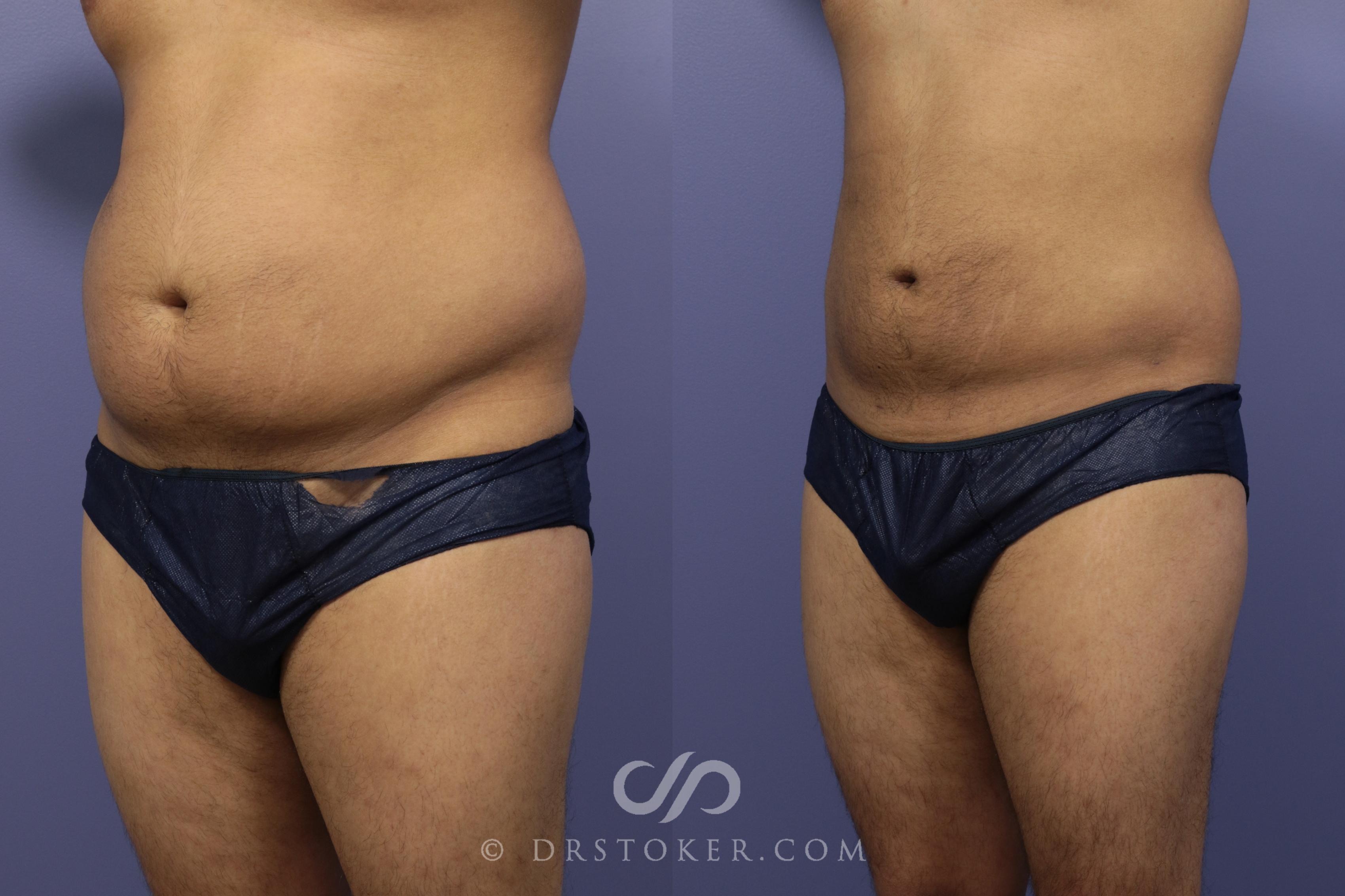 Before & After Liposuction Case 1086 View #2 View in Los Angeles, CA