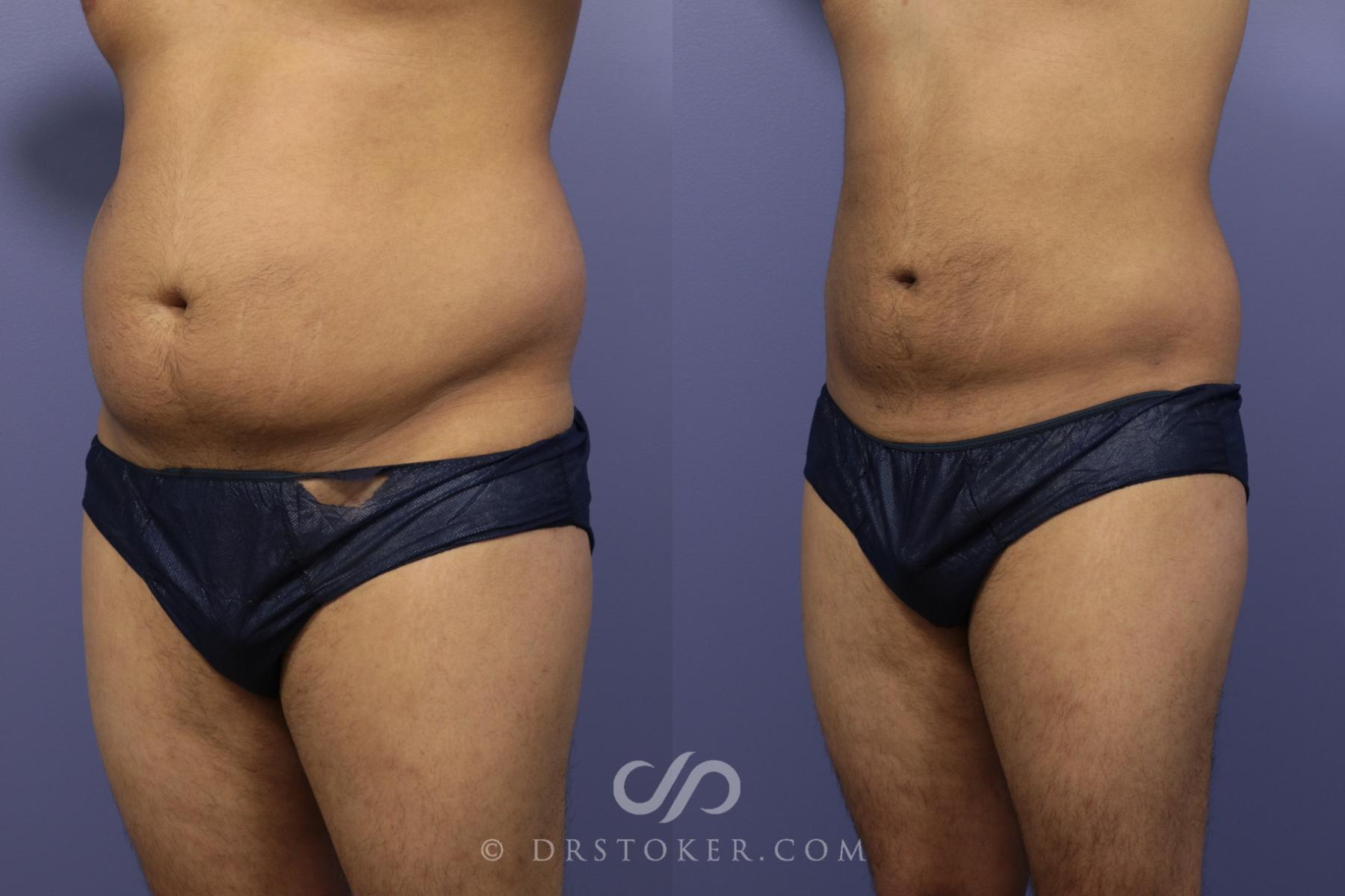 Before & After Liposuction for Men Case 1086 View #2 View in Los Angeles, CA