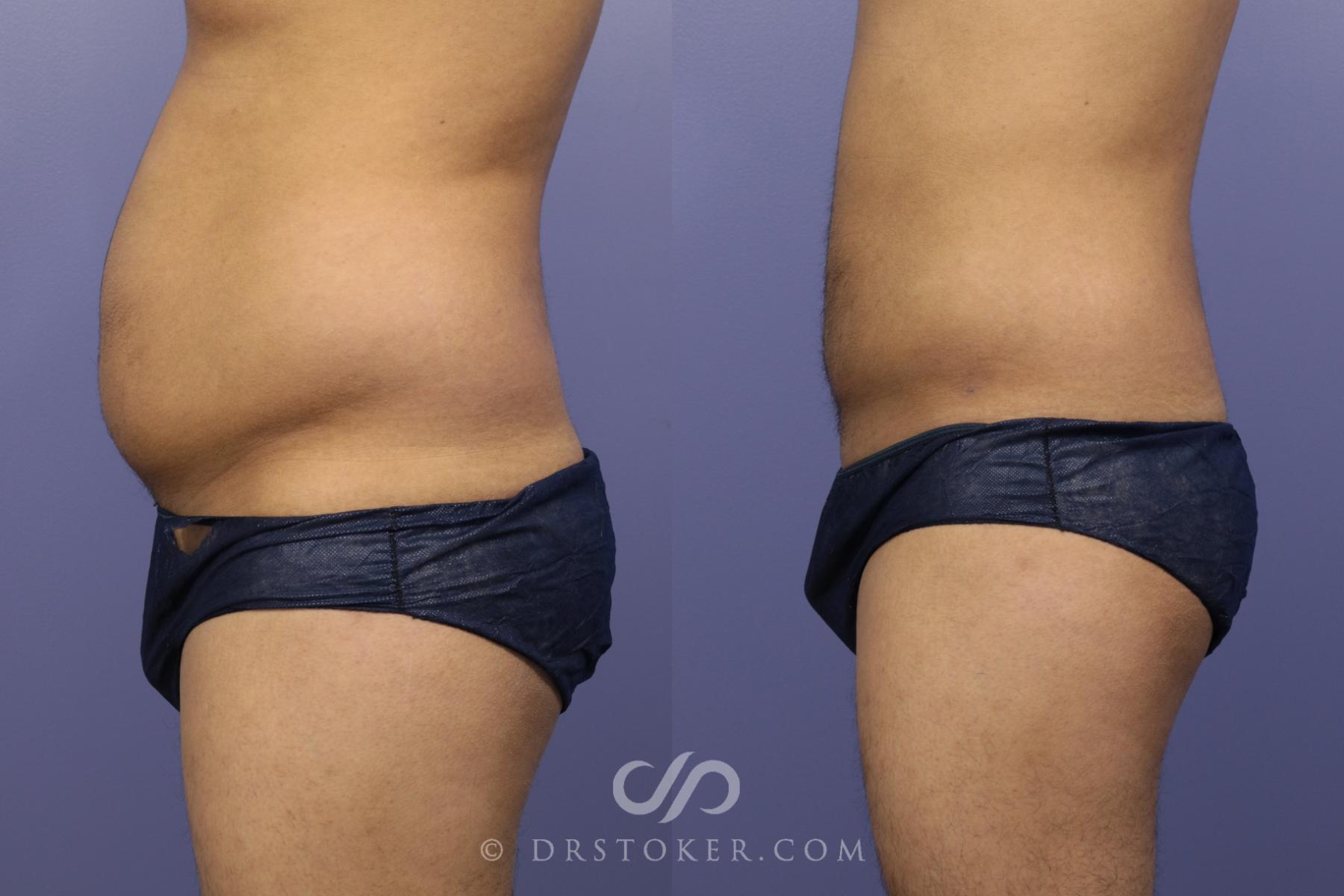 Before & After Liposuction for Men Case 1086 View #3 View in Los Angeles, CA