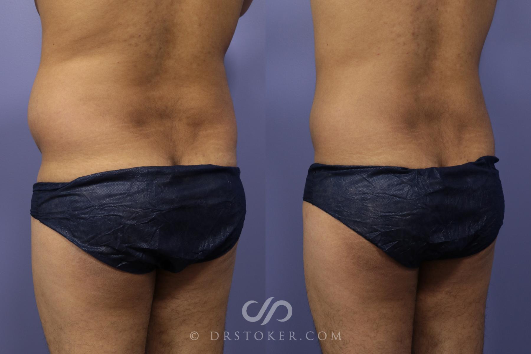 Before & After Liposuction for Men Case 1086 View #4 View in Los Angeles, CA
