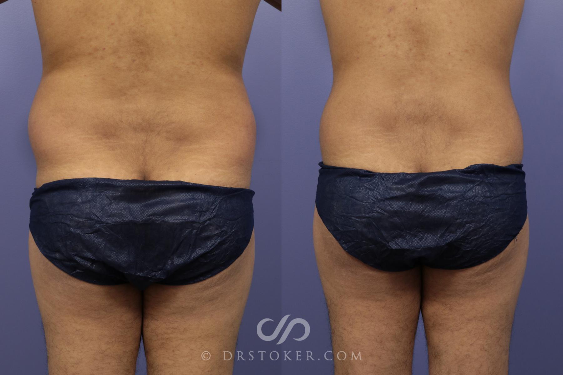 Before & After Liposuction for Men Case 1086 View #5 View in Los Angeles, CA