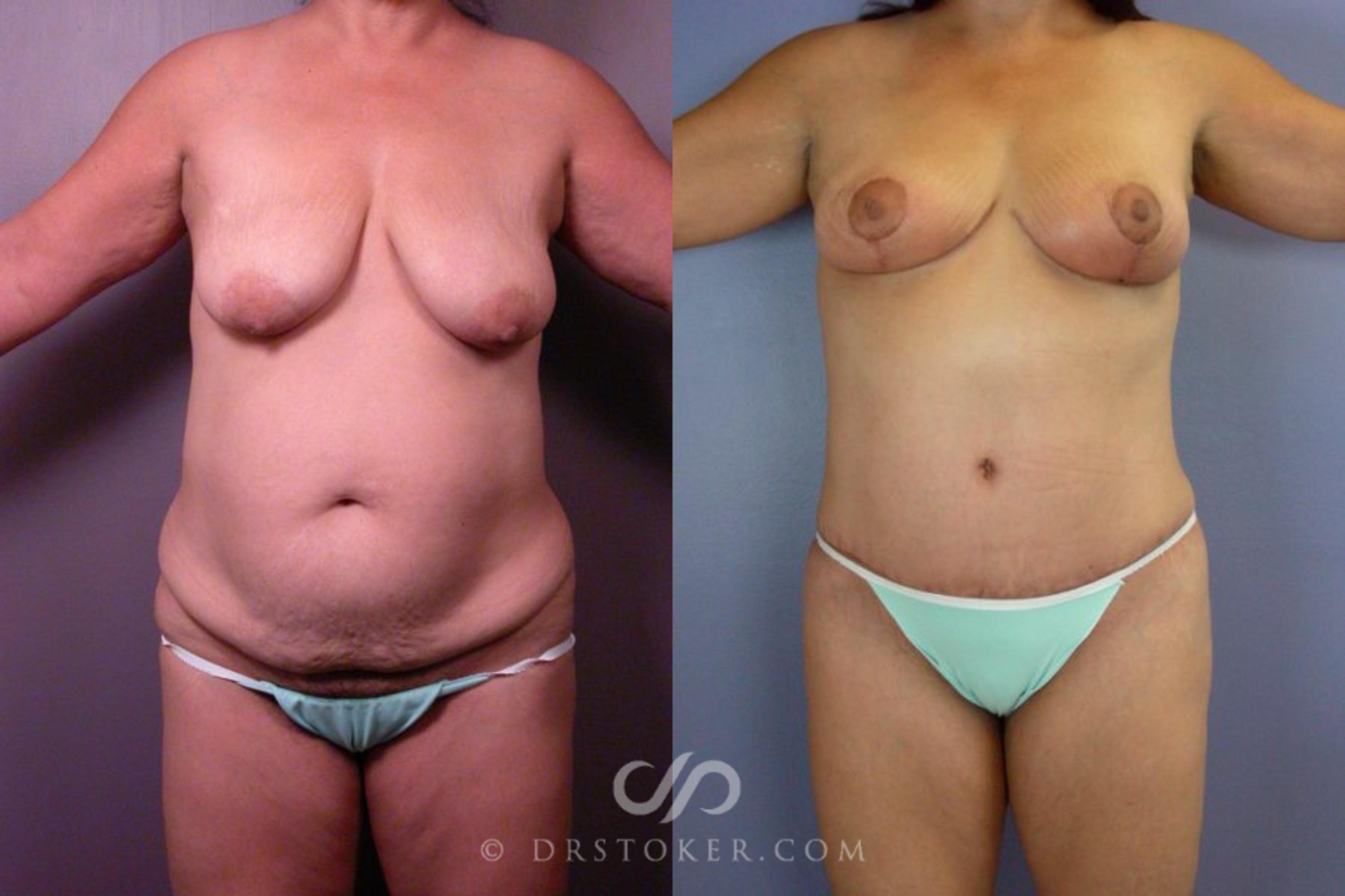 Before & After Tummy Tuck Case 113 View #1 View in Los Angeles, CA
