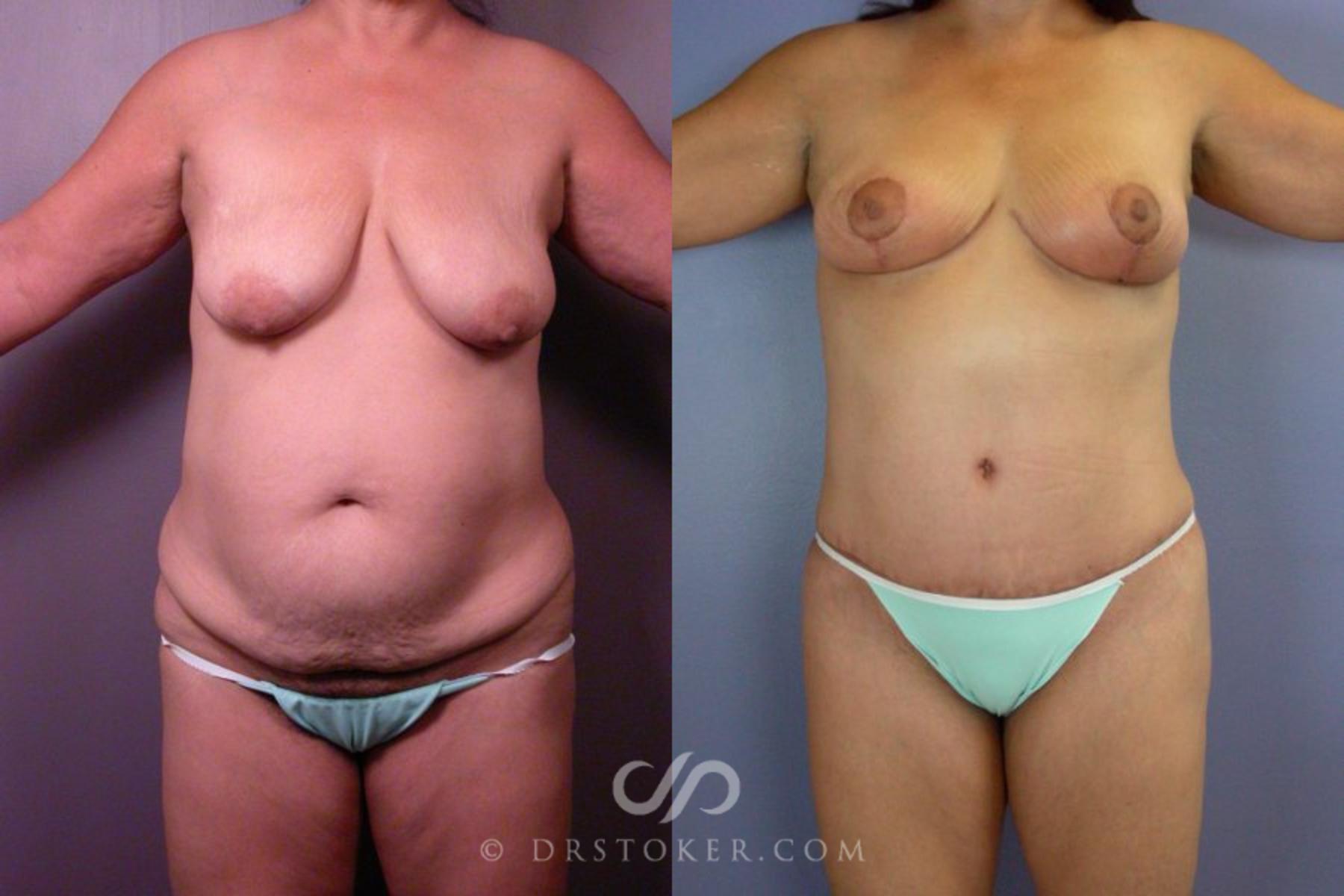 Before & After Liposuction Case 113 View #1 View in Los Angeles, CA