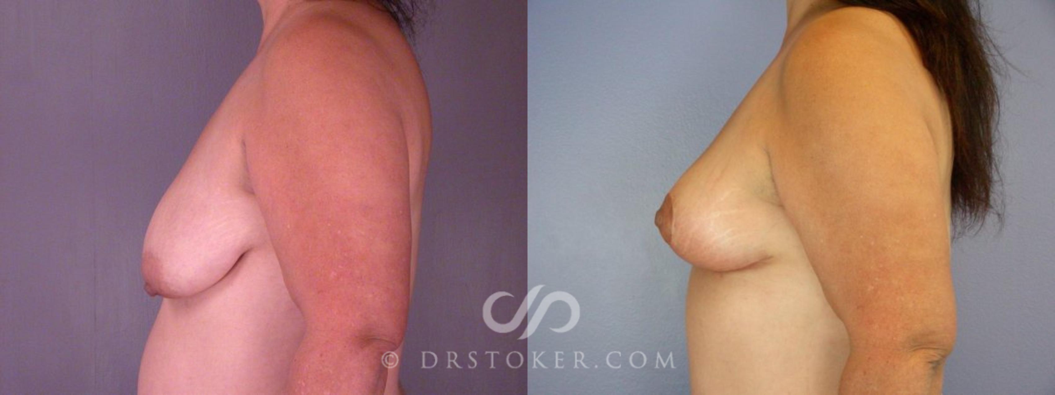 Before & After Liposuction Case 113 View #10 View in Los Angeles, CA