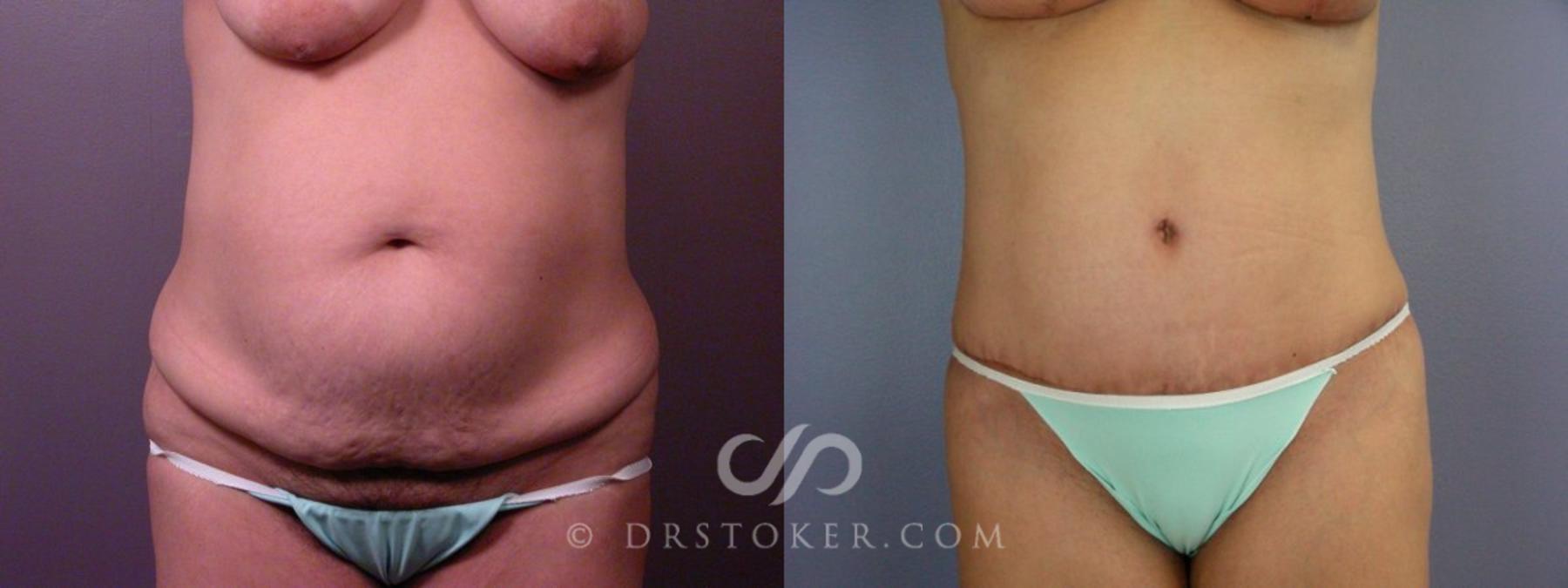 Before & After Tummy Tuck Case 113 View #11 View in Los Angeles, CA