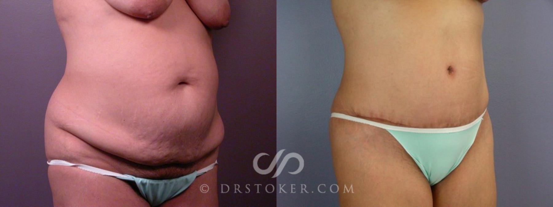 Before & After Tummy Tuck Case 113 View #12 View in Los Angeles, CA