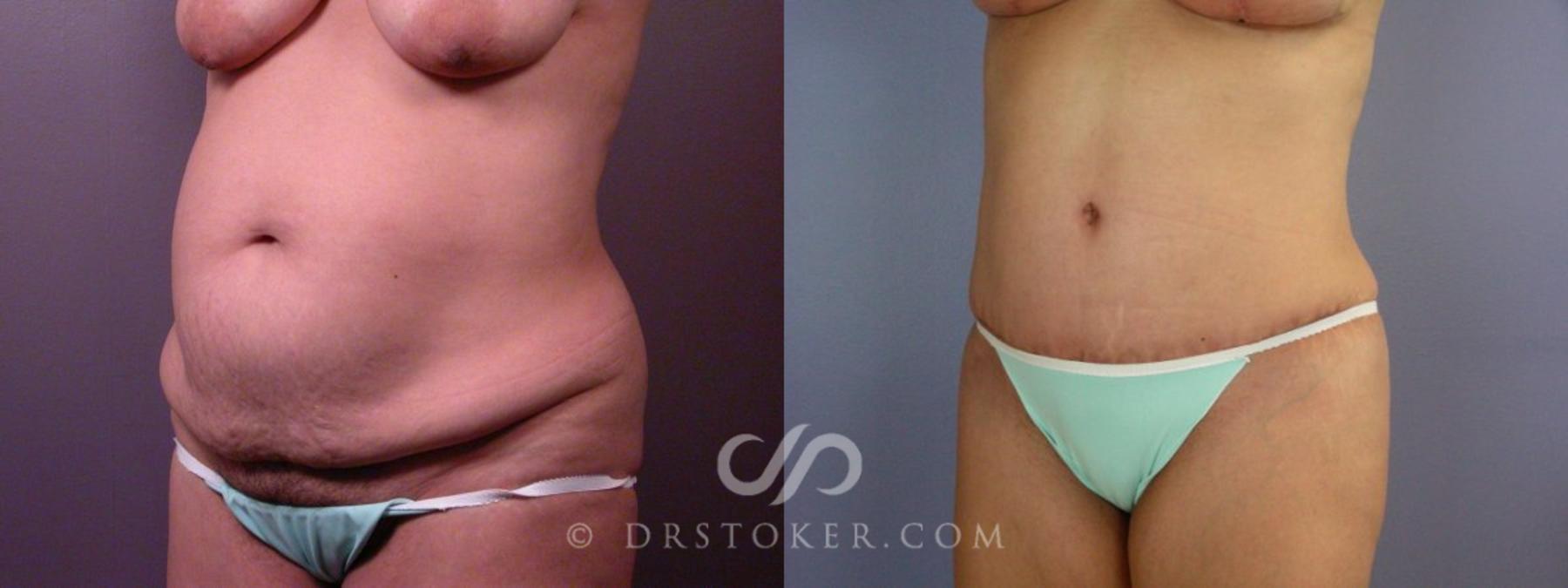 Before & After Liposuction Case 113 View #13 View in Los Angeles, CA