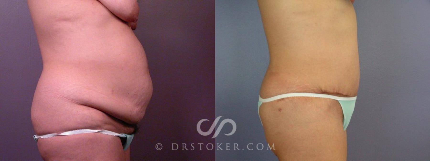 Before & After Tummy Tuck Case 113 View #14 View in Los Angeles, CA