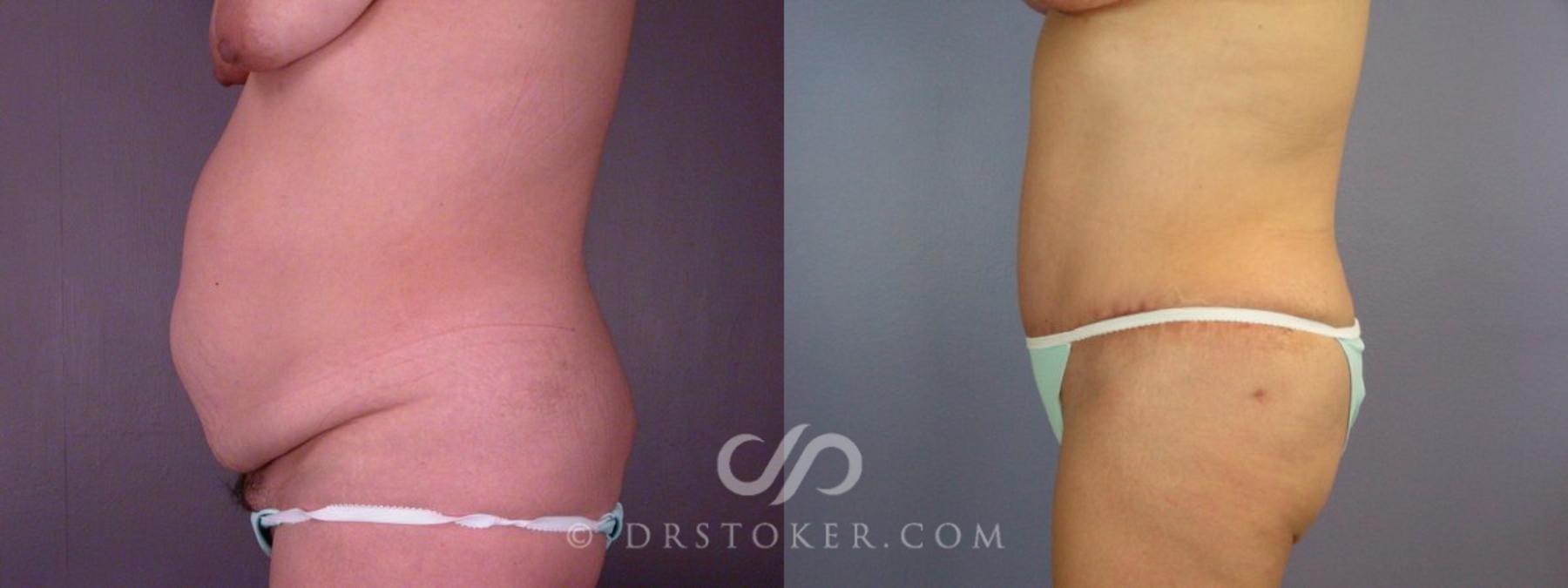 Before & After Liposuction Case 113 View #15 View in Los Angeles, CA