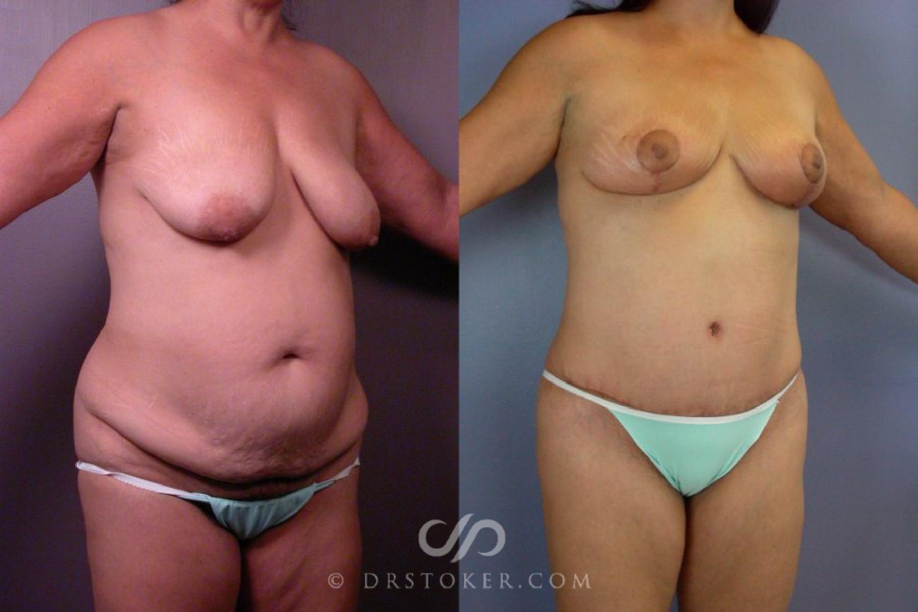 Before & After Tummy Tuck Case 113 View #2 View in Los Angeles, CA