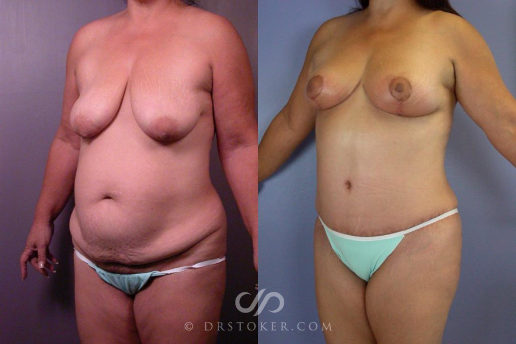 Before & After Tummy Tuck Case 113 View #3 View in Los Angeles, CA