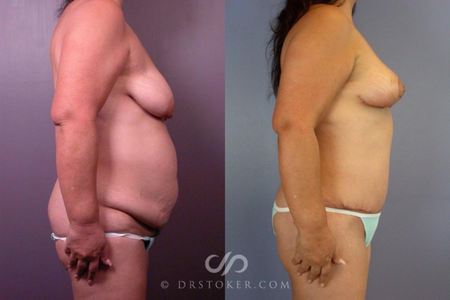 Before & After Liposuction Case 113 View #4 View in Los Angeles, CA
