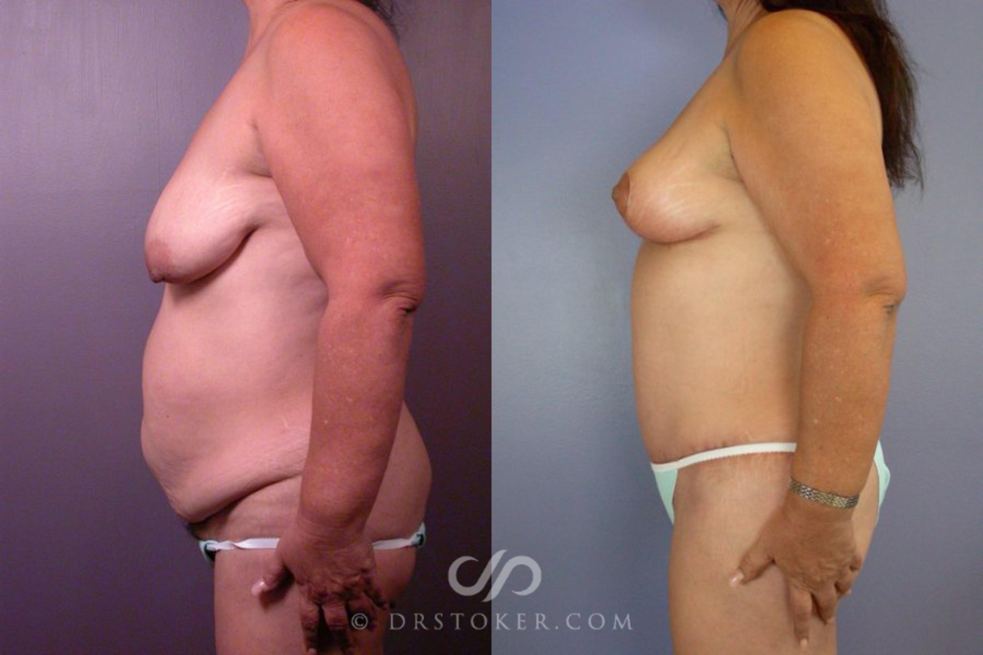 Before & After Liposuction Case 113 View #5 View in Los Angeles, CA