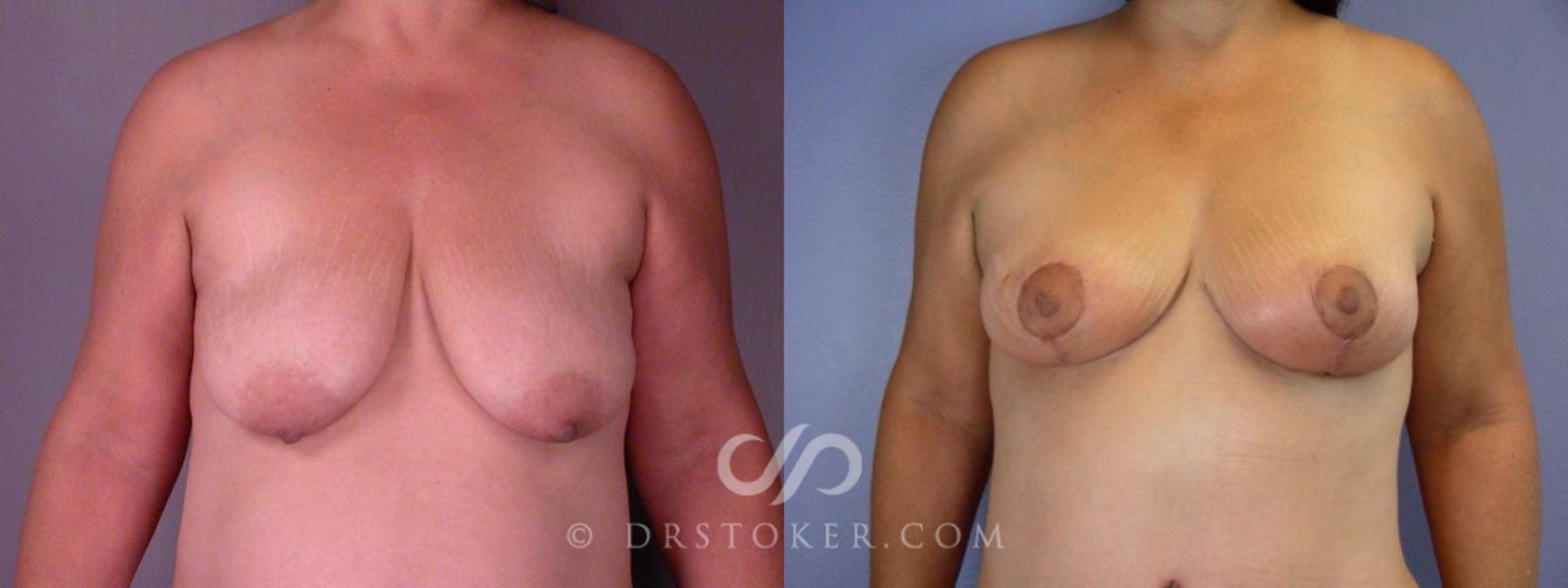 Before & After Tummy Tuck Case 113 View #6 View in Los Angeles, CA