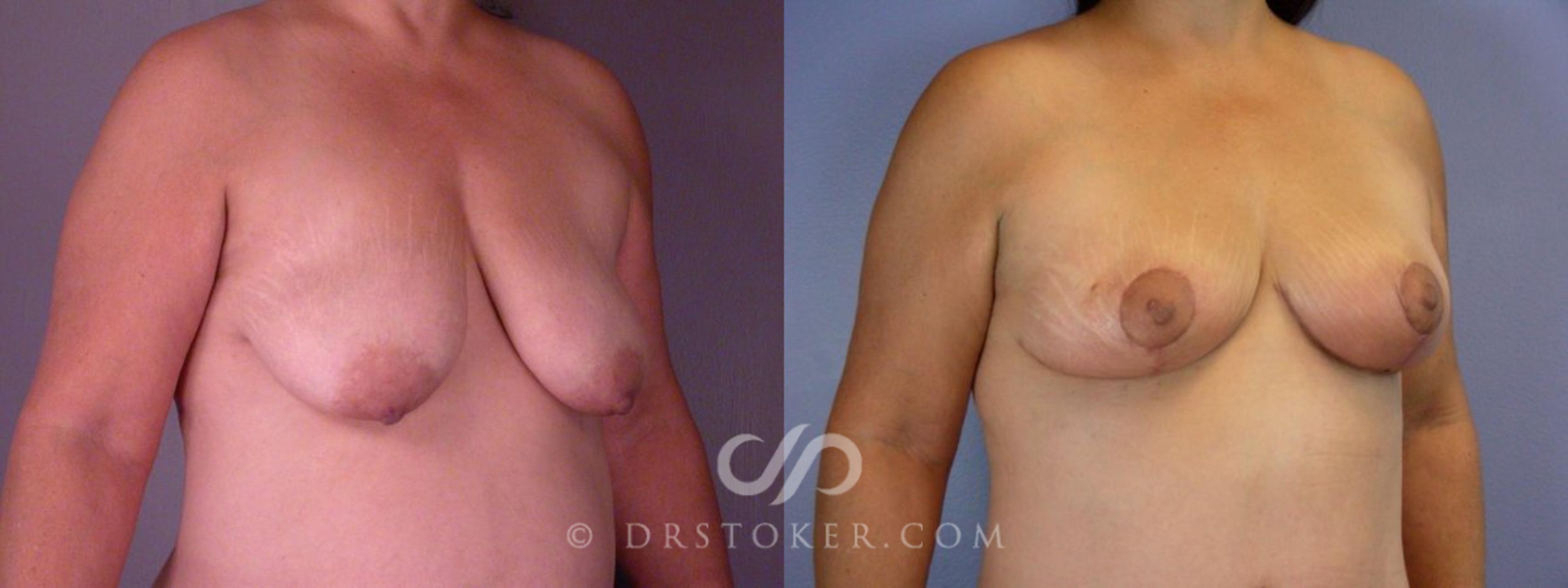 Before & After Liposuction Case 113 View #7 View in Los Angeles, CA