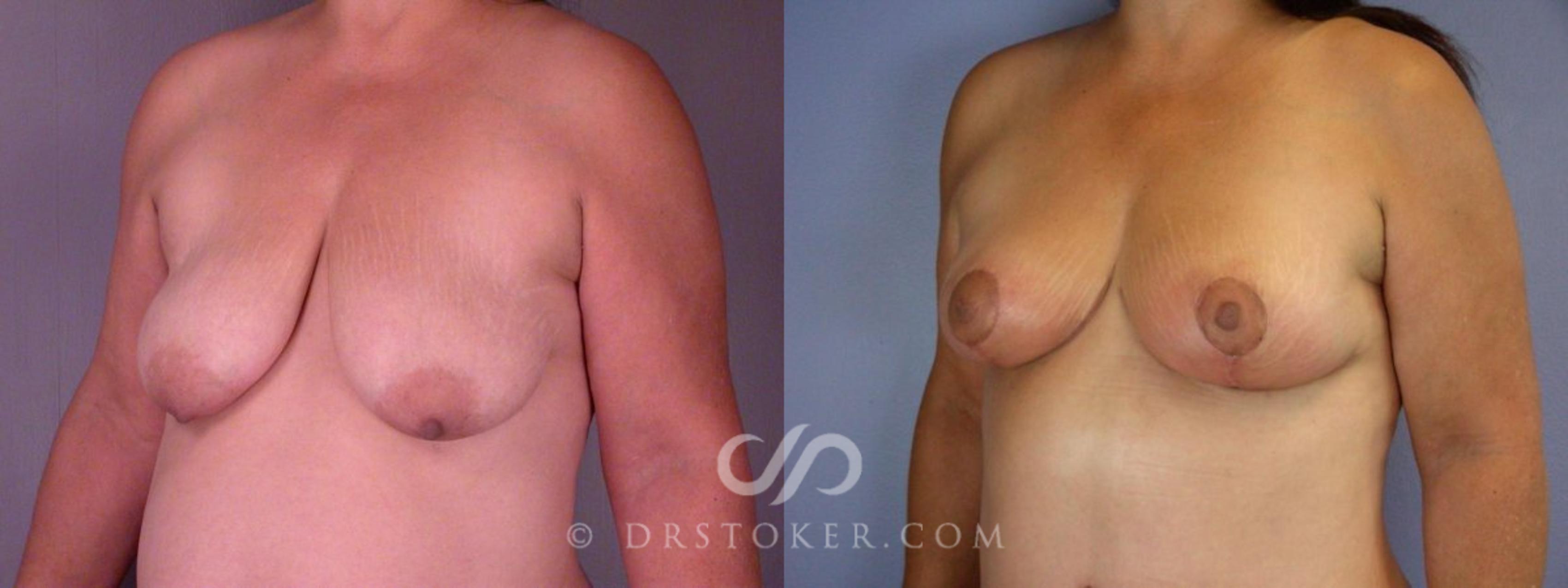 Before & After Liposuction Case 113 View #8 View in Los Angeles, CA