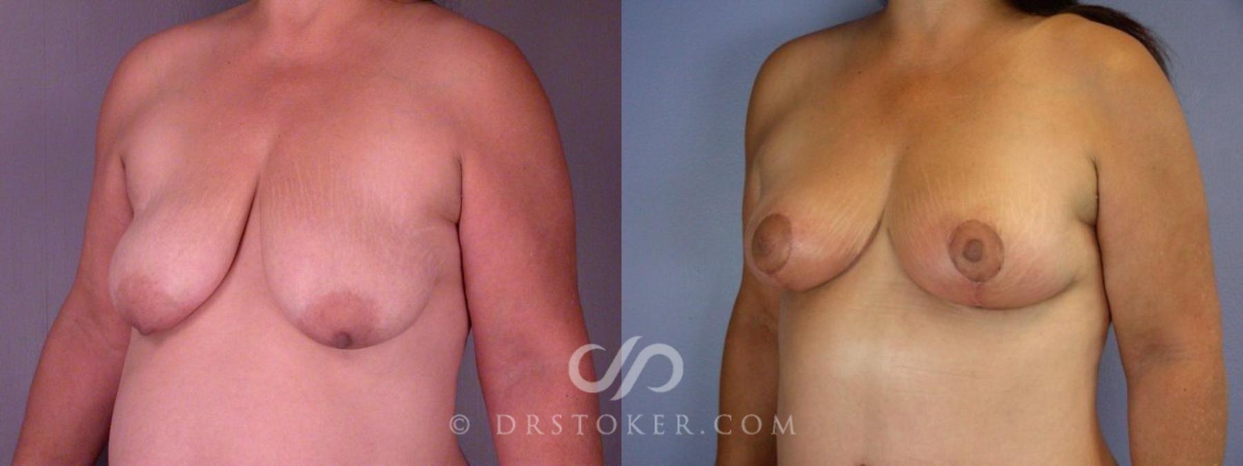 Before & After Tummy Tuck Case 113 View #8 View in Los Angeles, CA