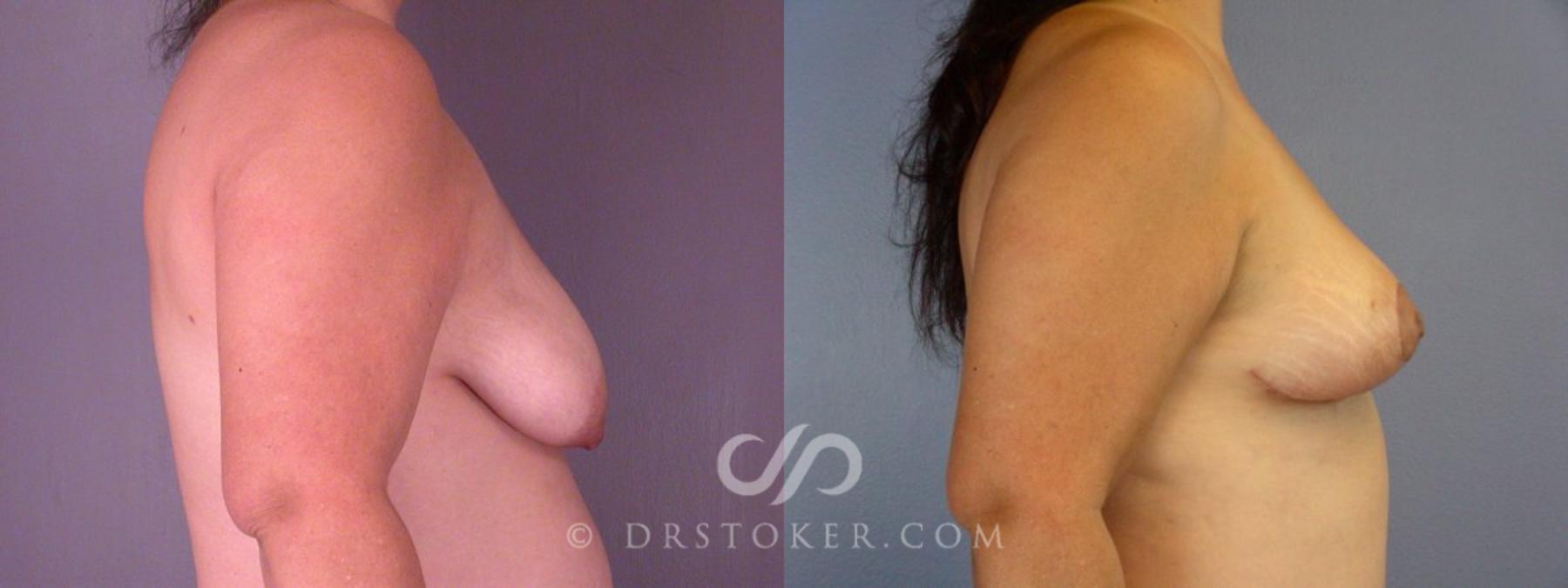 Before & After Liposuction Case 113 View #9 View in Los Angeles, CA
