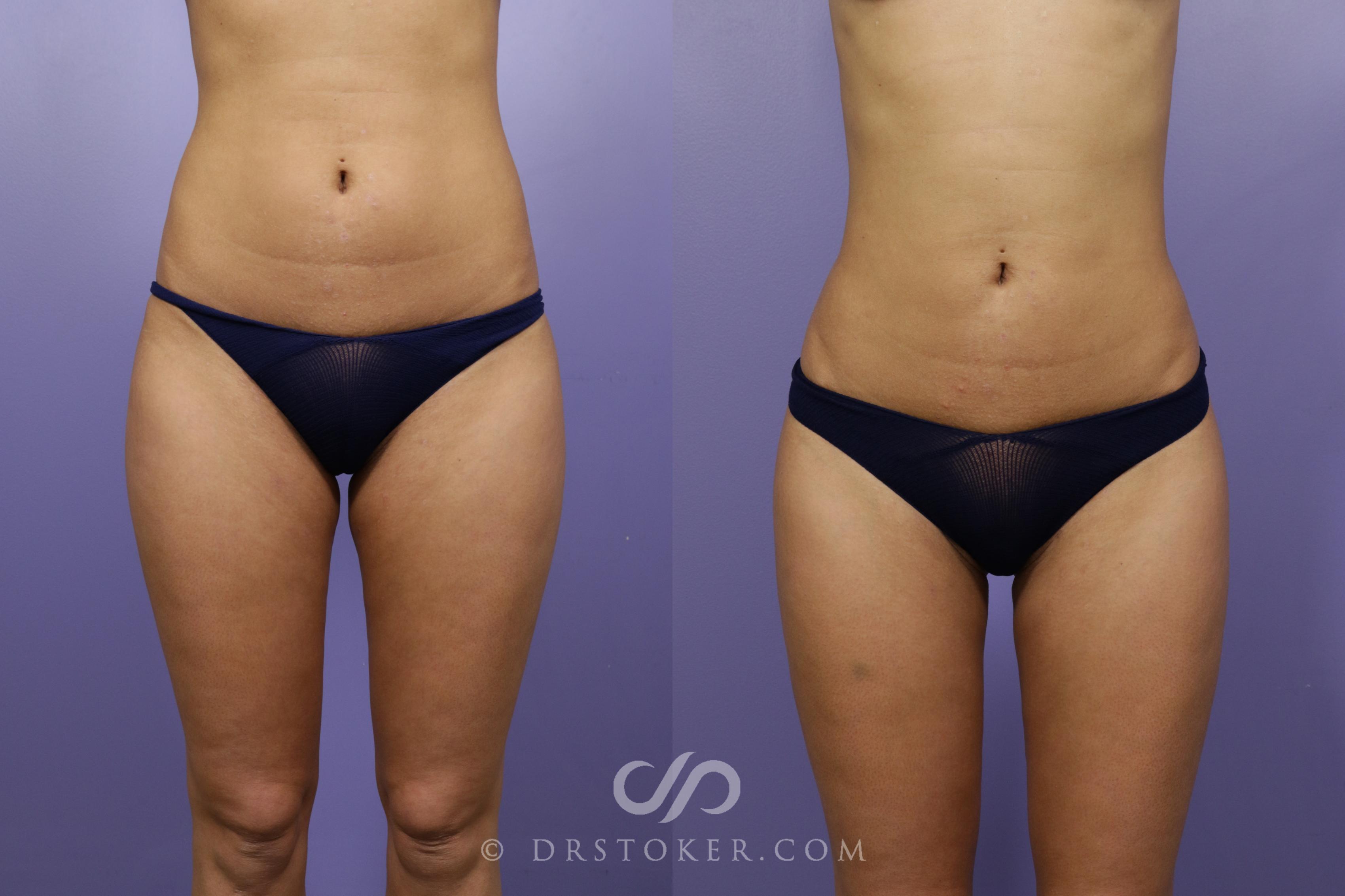 Abdomen and Waist Liposuction - Before and After Photos