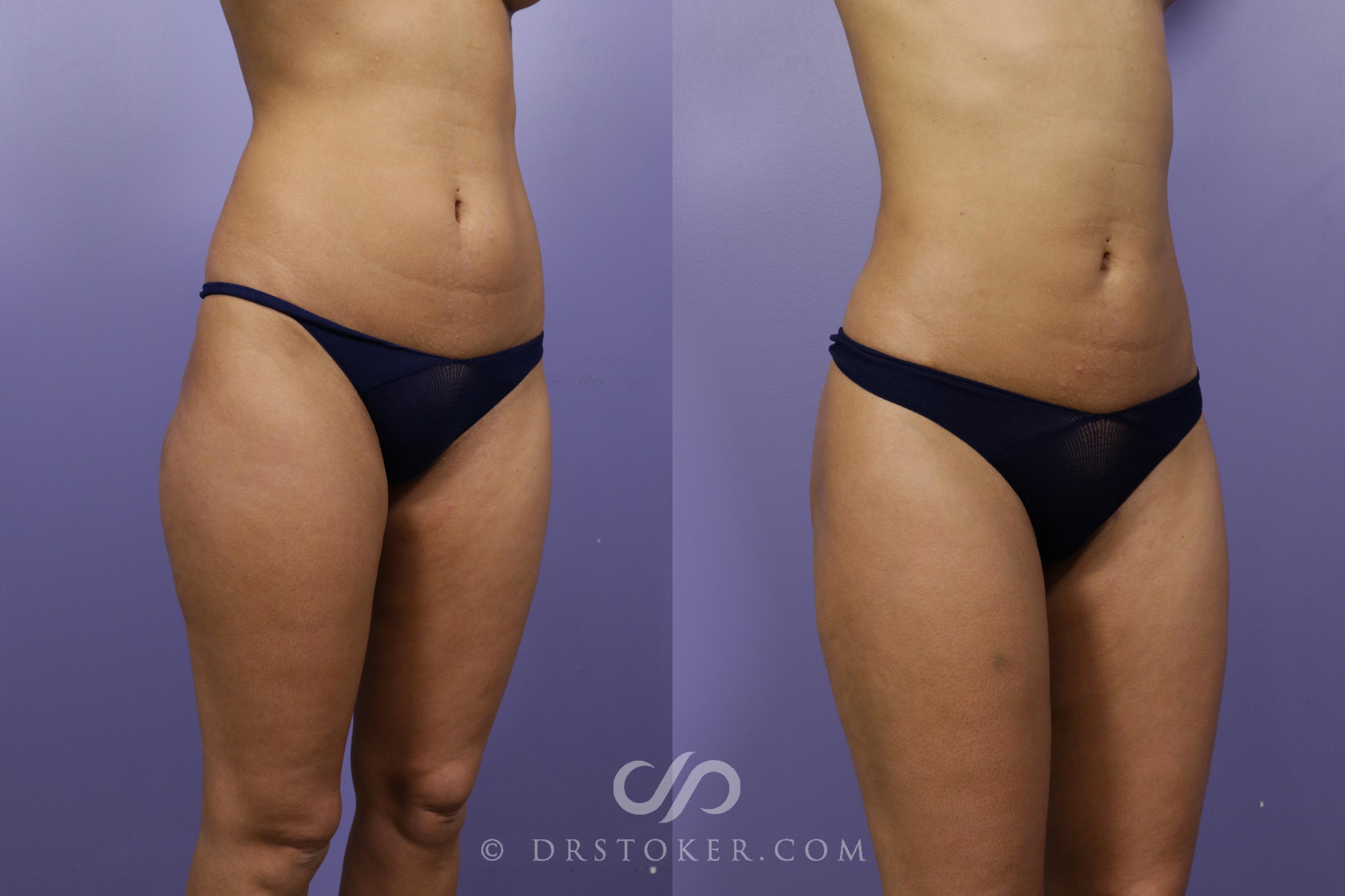 Before & After Liposuction Case 1312 View #2 View in Los Angeles, CA