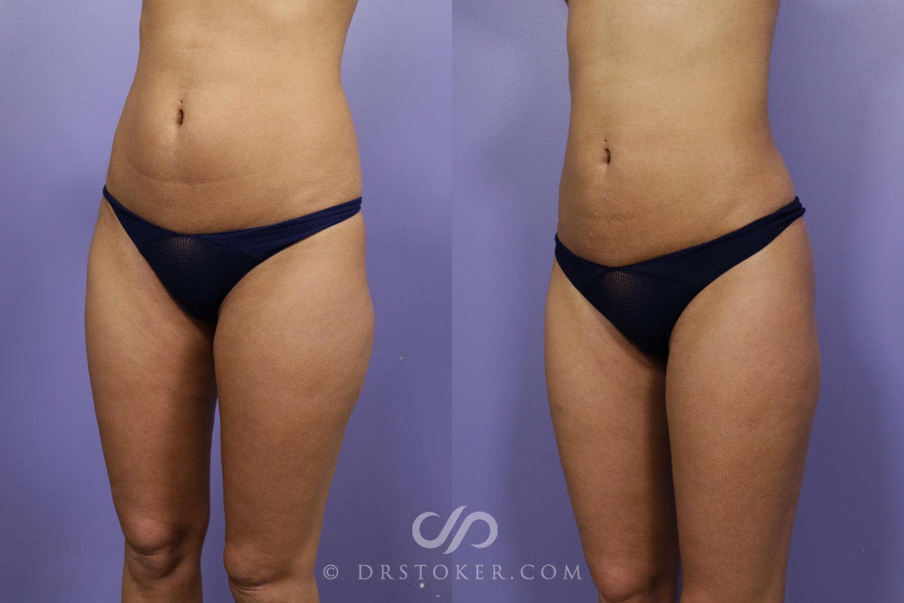 Before & After Liposuction Case 1312 View #3 View in Los Angeles, CA
