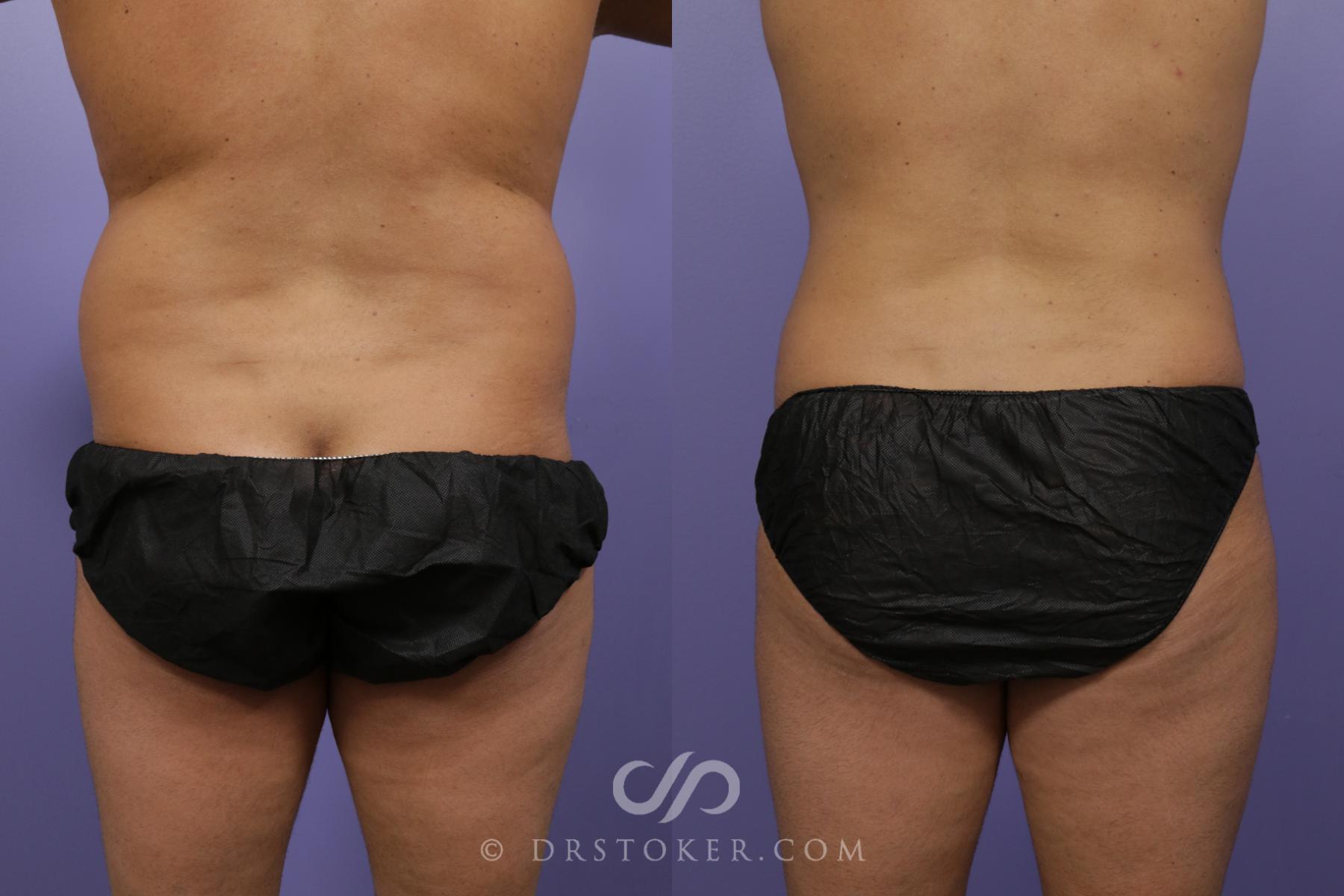 Before & After Liposuction Case 1313 View #1 View in Los Angeles, CA