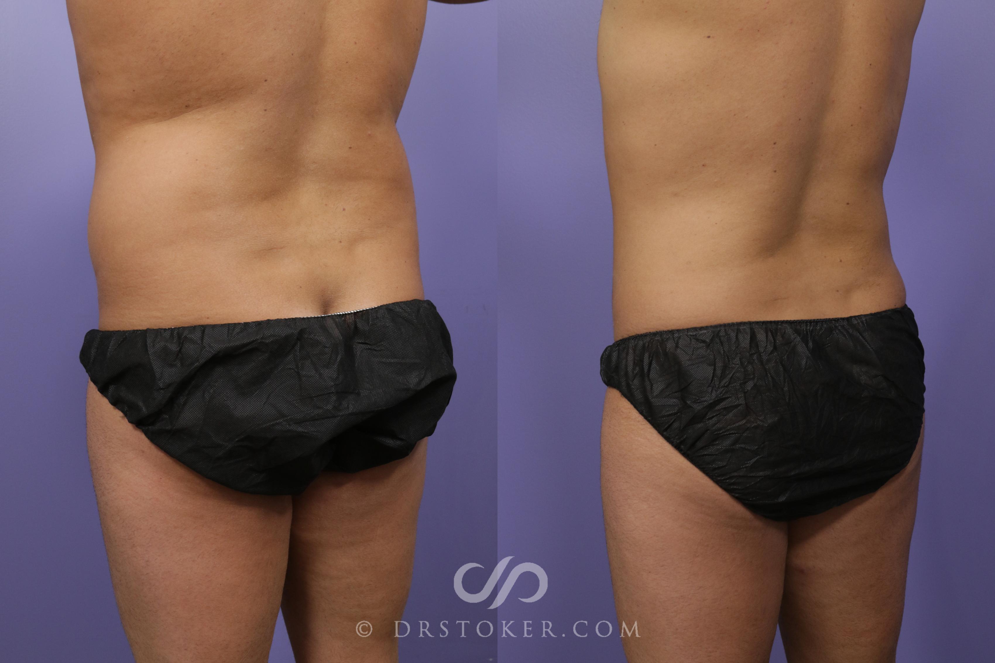 Before & After Liposuction Case 1313 View #2 View in Los Angeles, CA