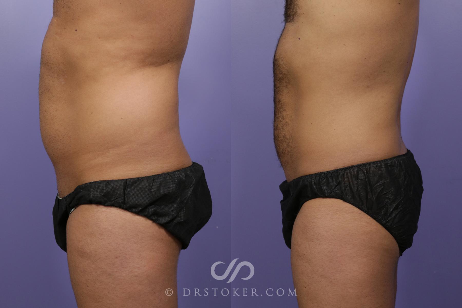 Before & After Liposuction Case 1313 View #3 View in Los Angeles, CA