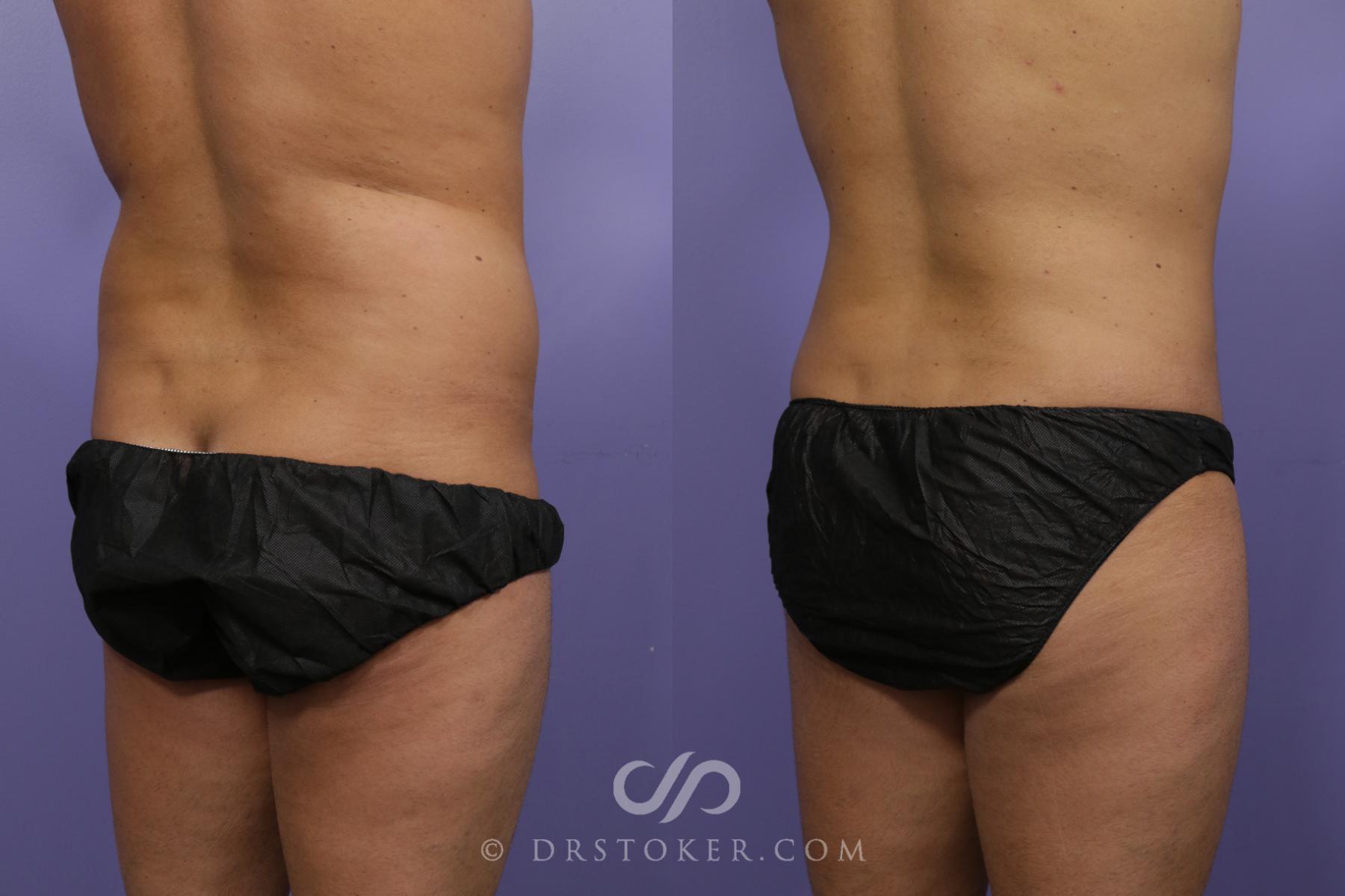 Before & After Liposuction Case 1313 View #4 View in Los Angeles, CA
