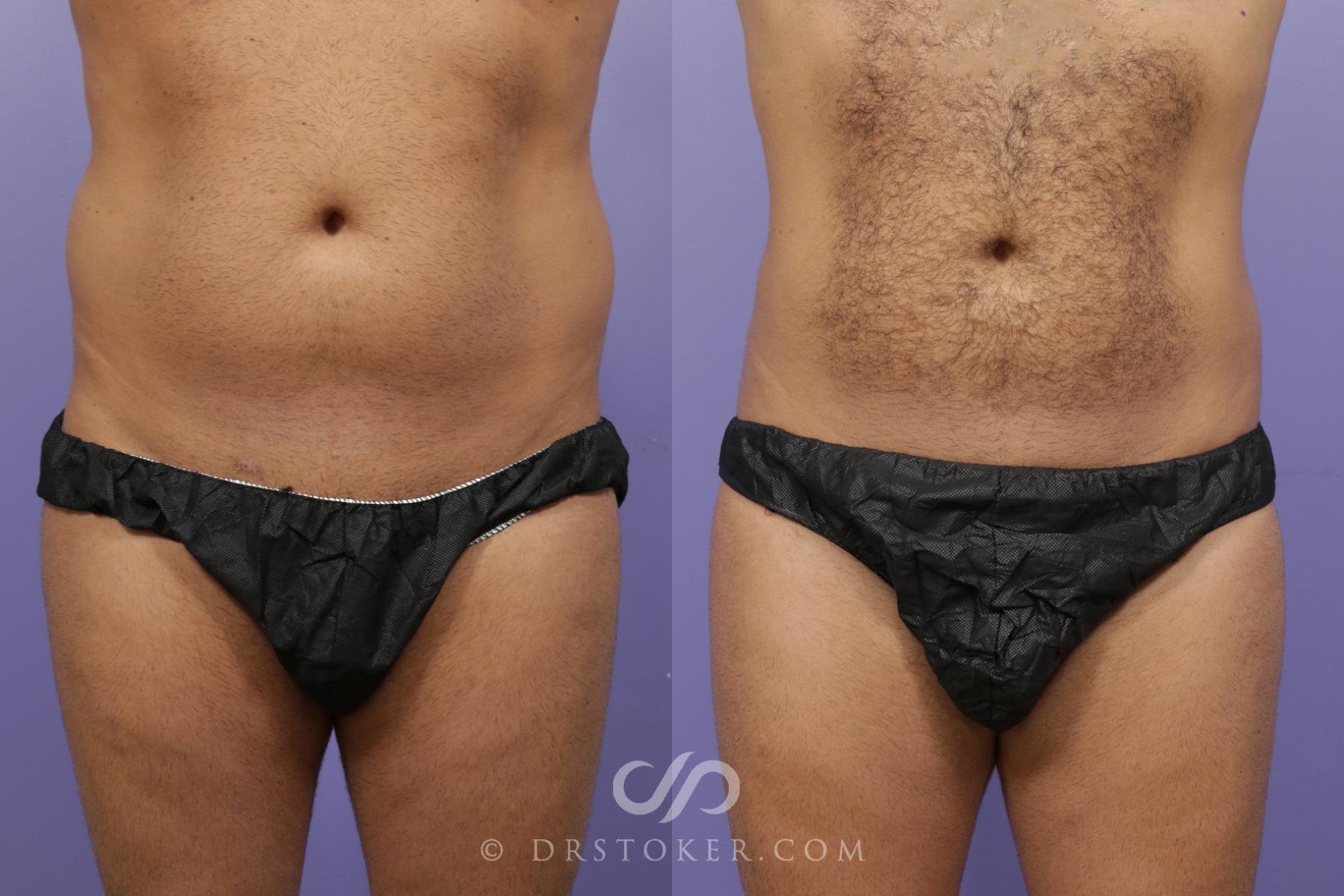 Before & After Liposuction Case 1314 View #1 View in Los Angeles, CA