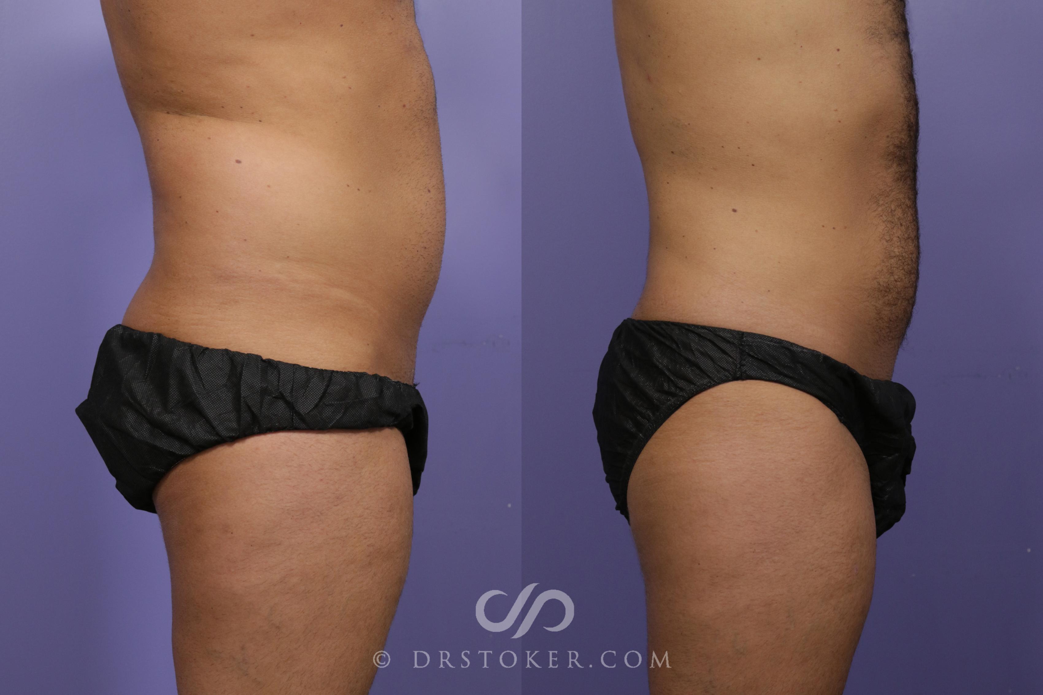 Before & After Liposuction Case 1314 View #2 View in Los Angeles, CA