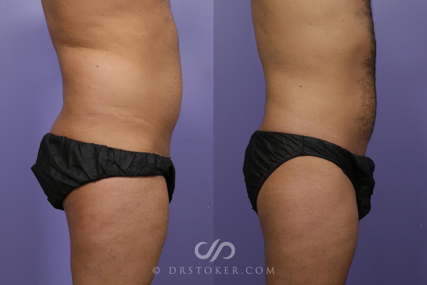 Before & After Liposuction Case 1314 View #2 View in Los Angeles, CA