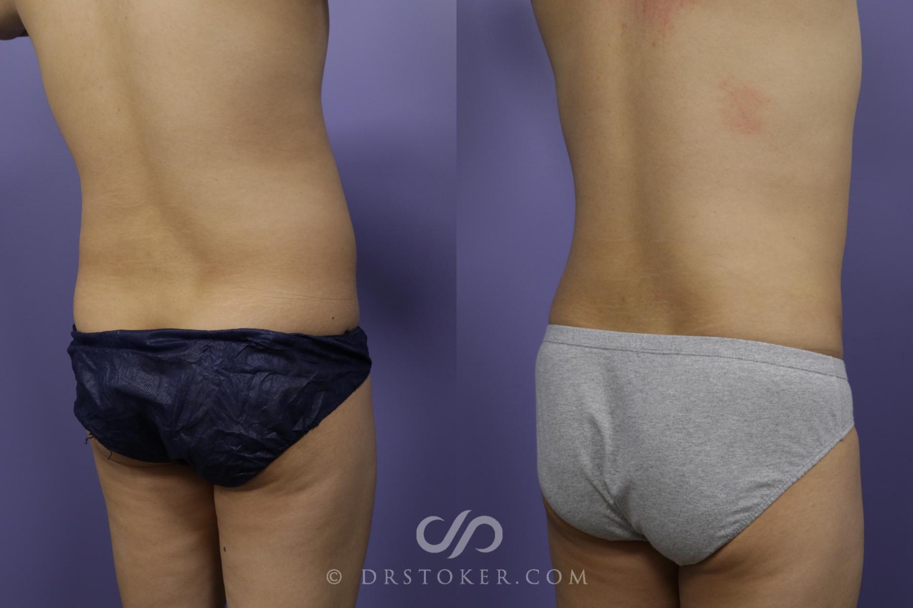 Before & After Liposuction Case 1315 View #1 View in Los Angeles, CA