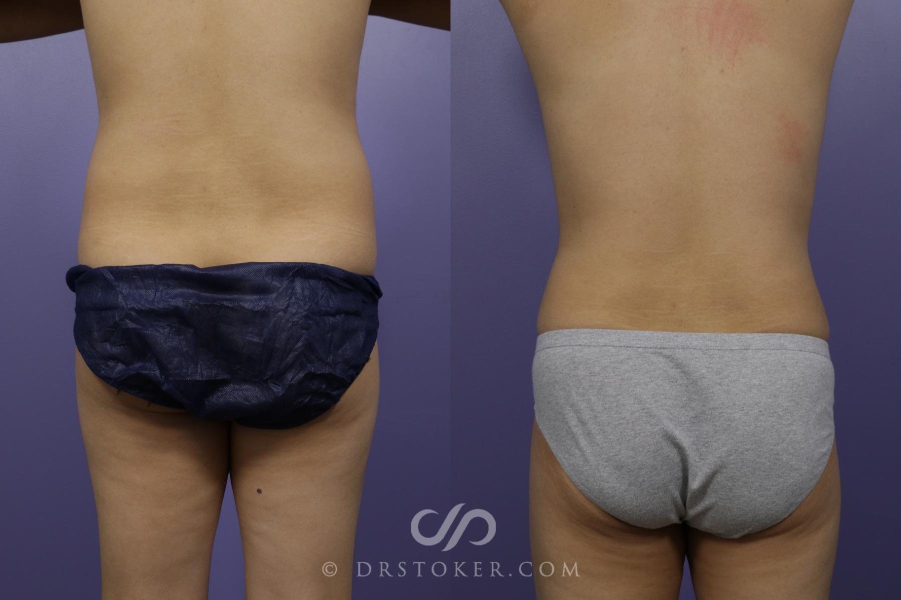 Before & After Liposuction Case 1315 View #2 View in Los Angeles, CA