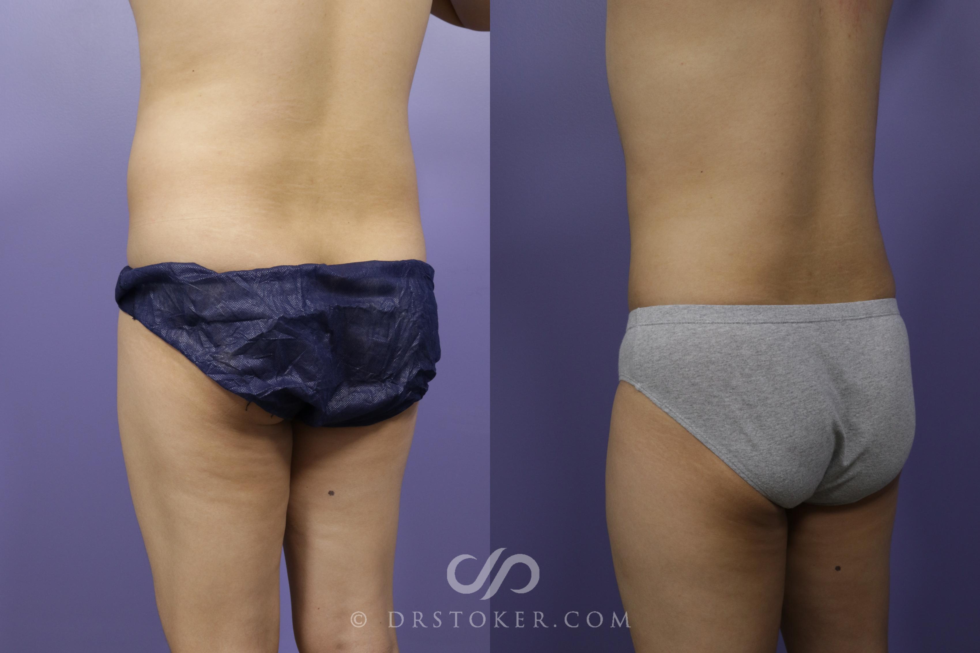 Before & After Liposuction Case 1315 View #3 View in Los Angeles, CA