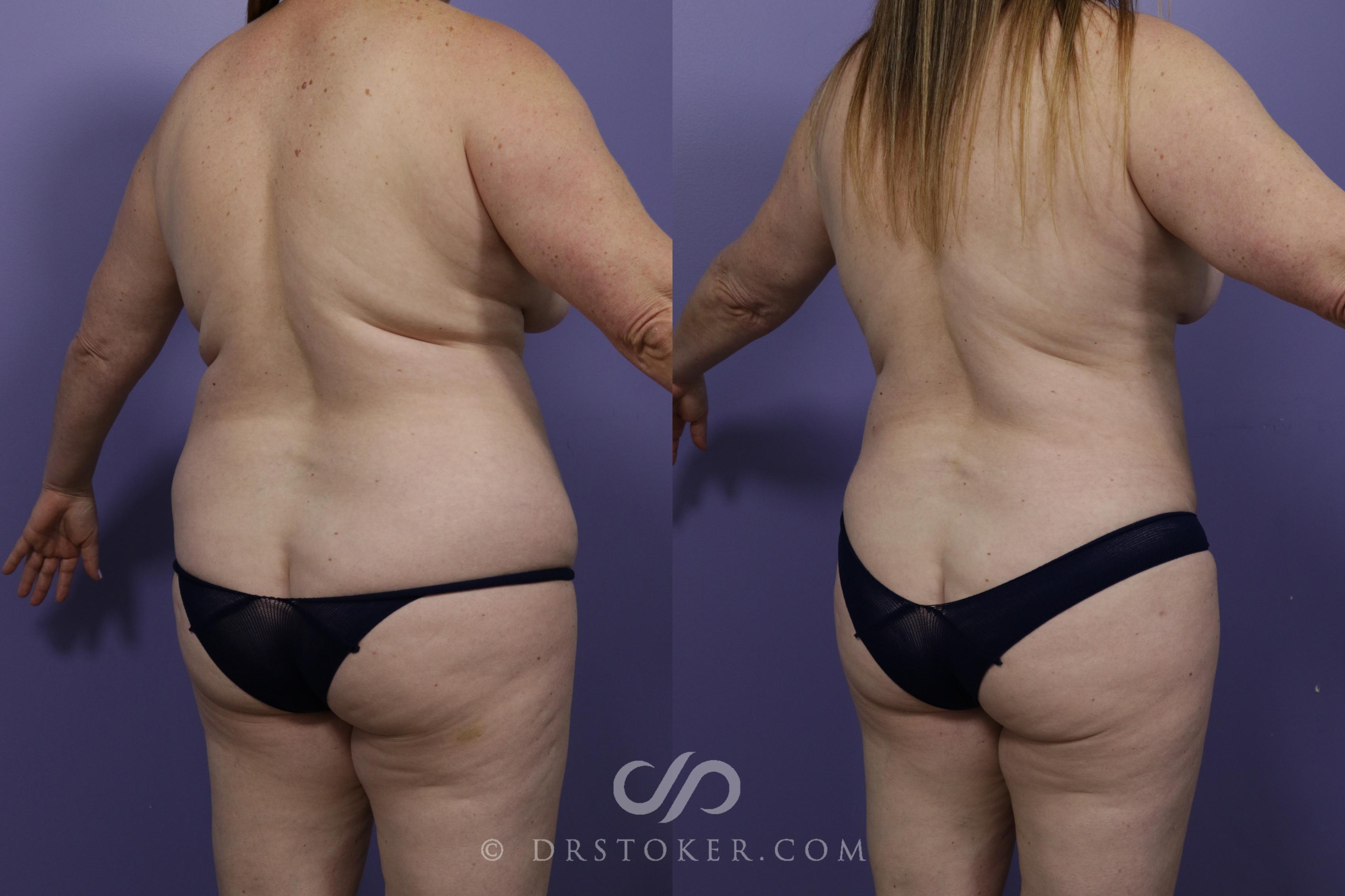Before & After Liposuction Case 1316 View #1 View in Los Angeles, CA