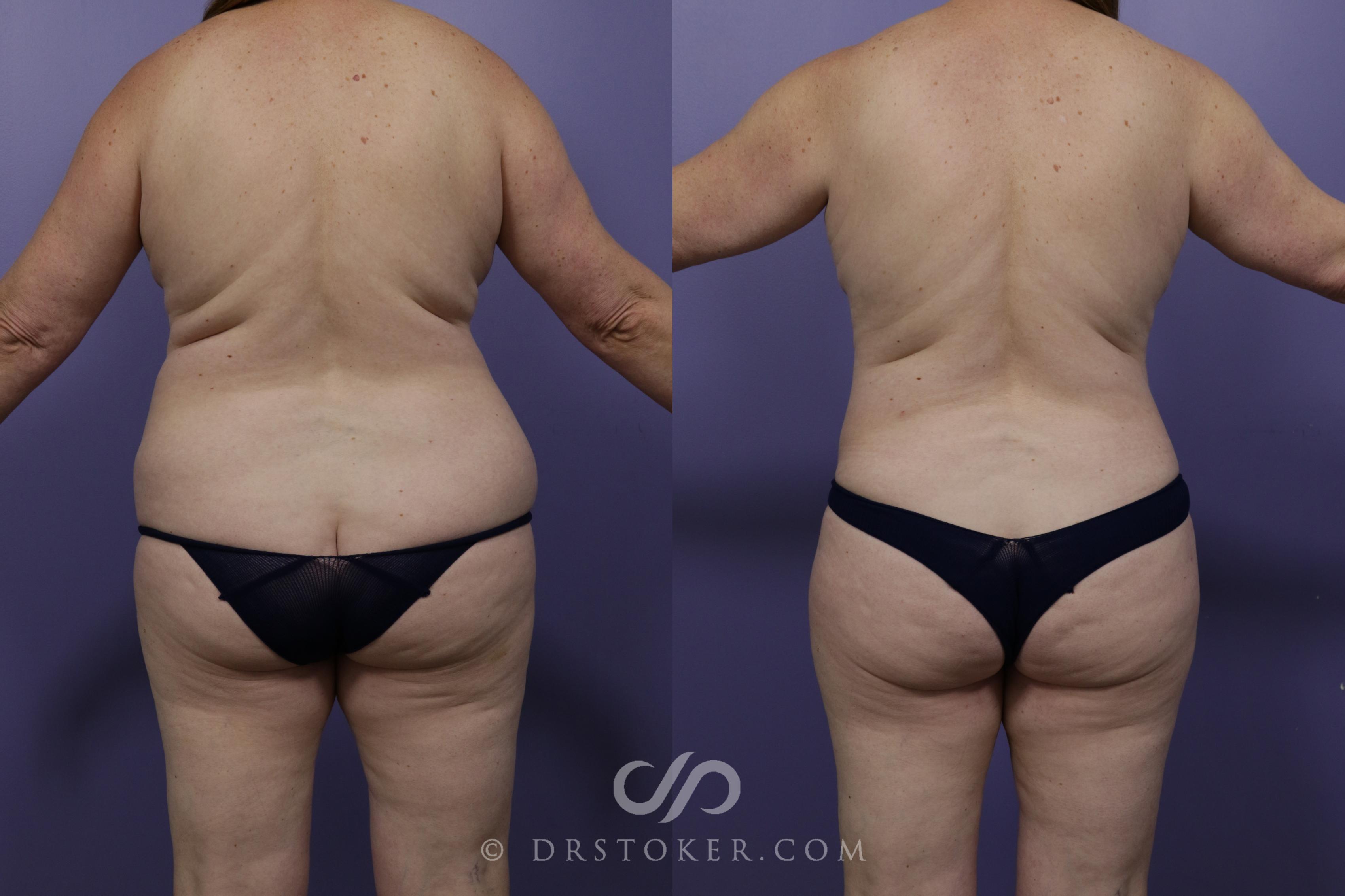 Before & After Liposuction Case 1316 View #2 View in Los Angeles, CA