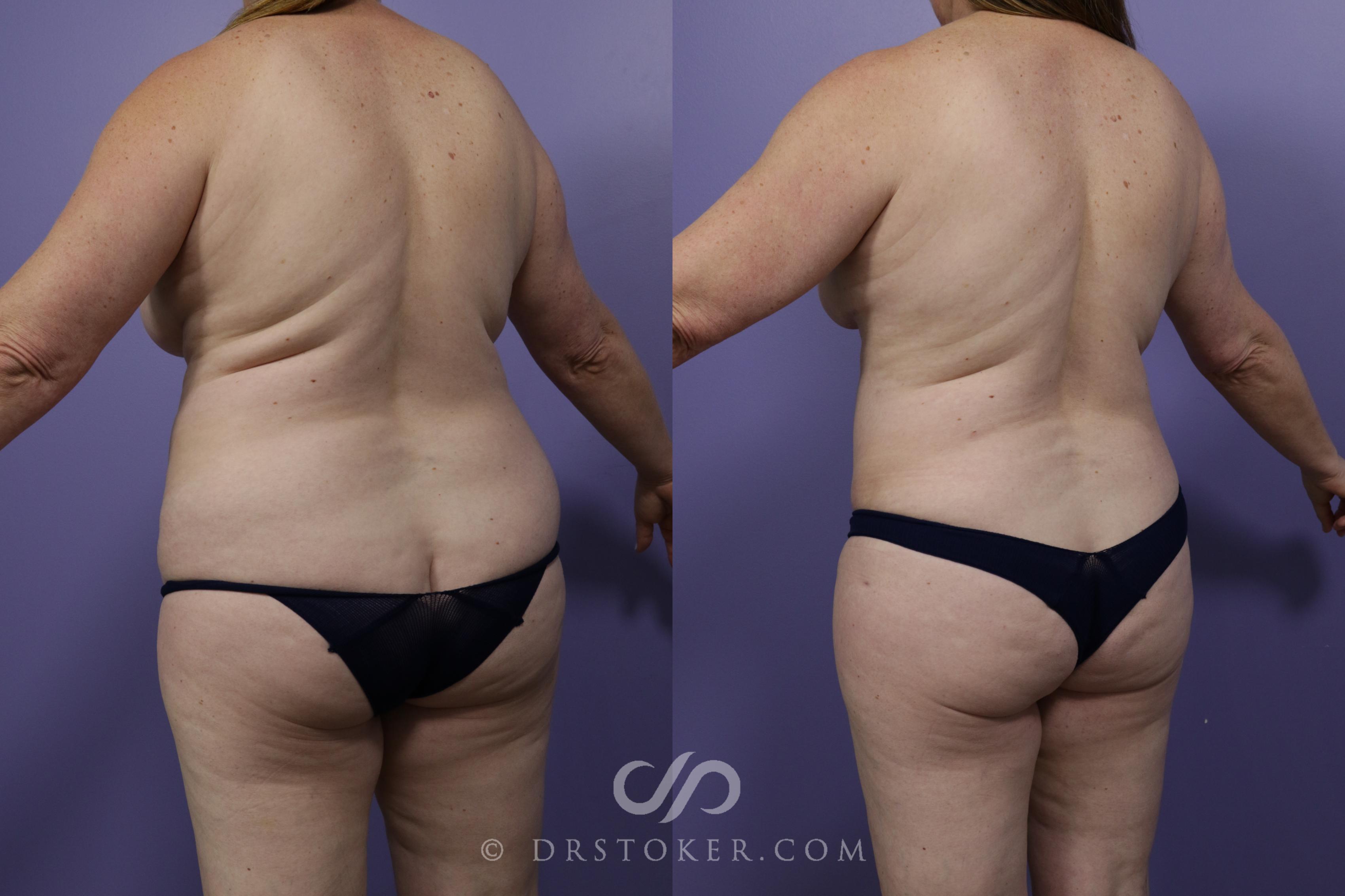 Before & After Liposuction Case 1316 View #3 View in Los Angeles, CA