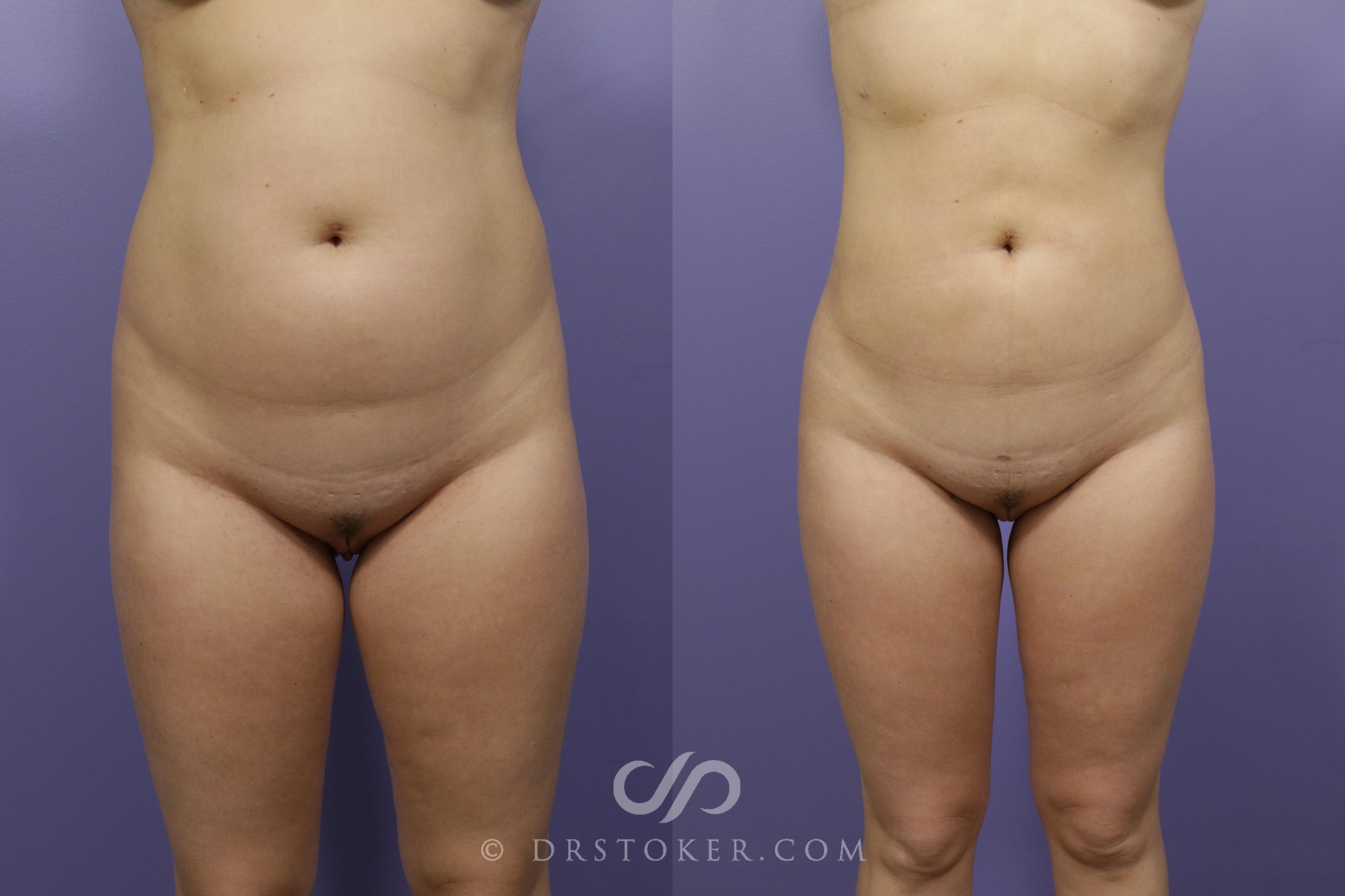 Before & After Liposuction - Abdominal Etching & Sculpting Case 1317 View #1 View in Los Angeles, CA
