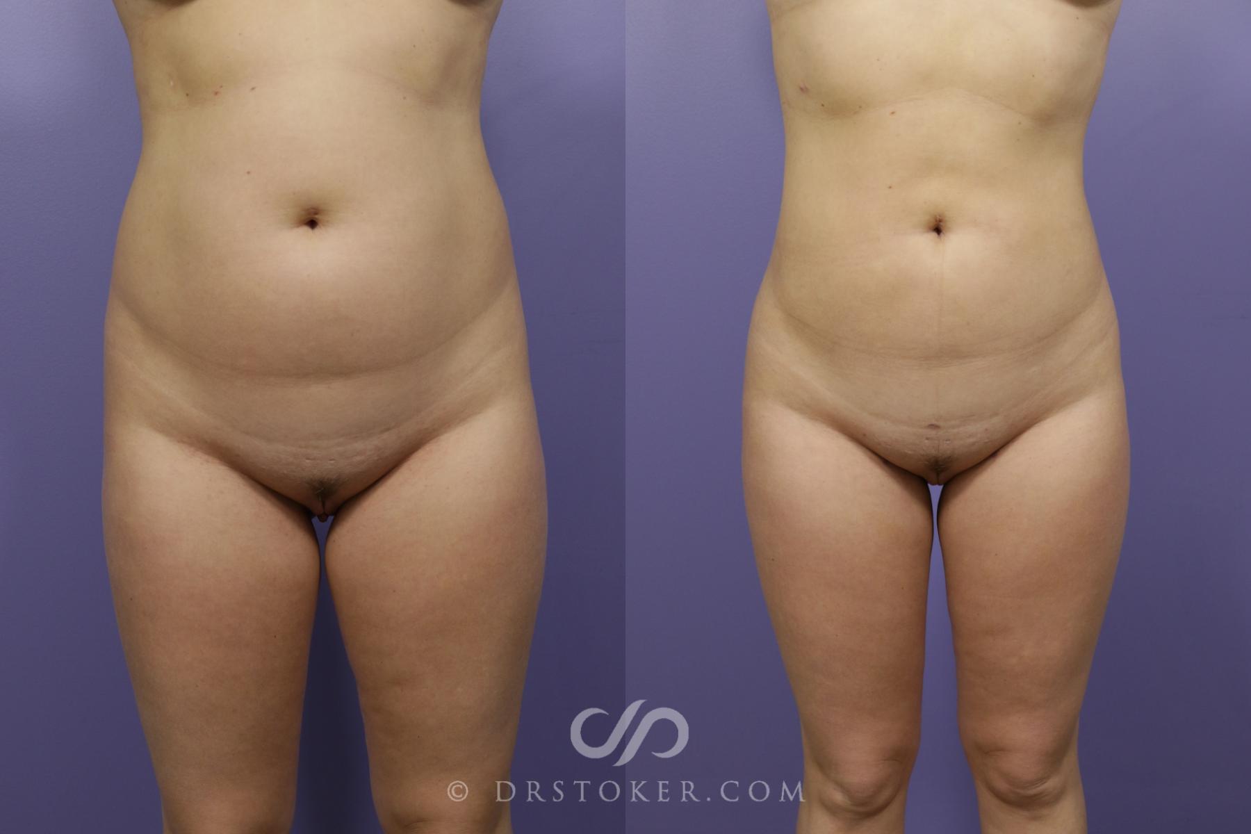 Before & After Liposuction Case 1317 View #1 View in Los Angeles, CA