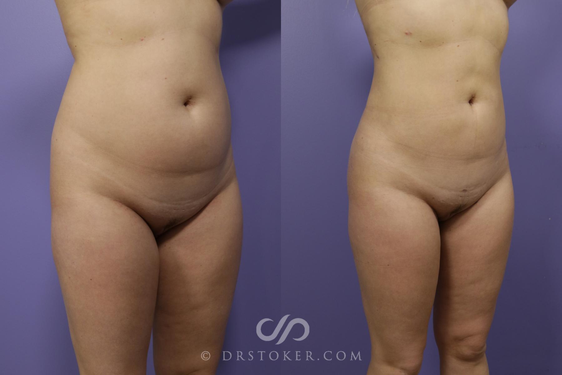 Before & After Liposuction Case 1317 View #2 View in Los Angeles, CA