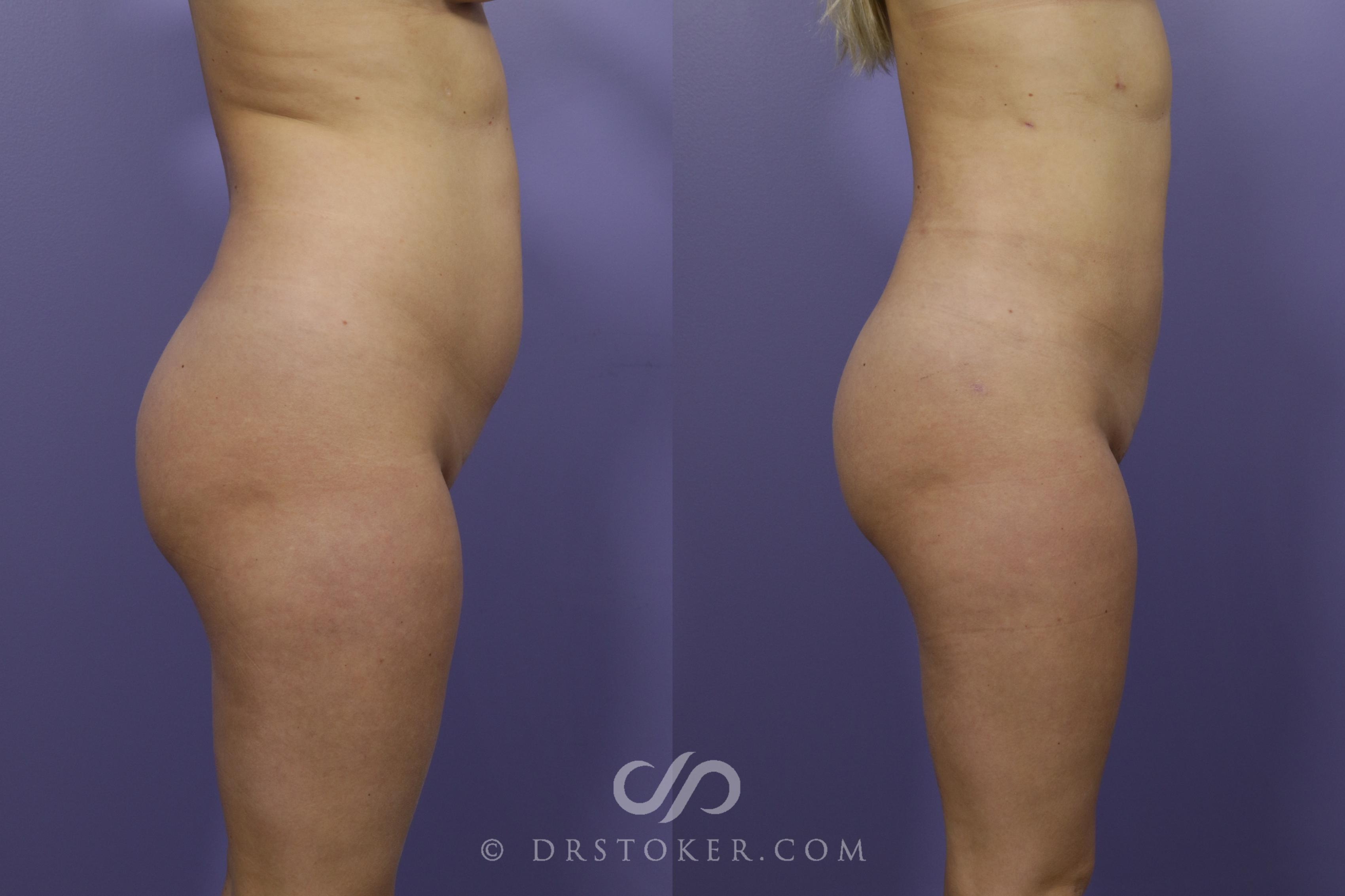 Before & After Liposuction Case 1317 View #3 View in Los Angeles, CA