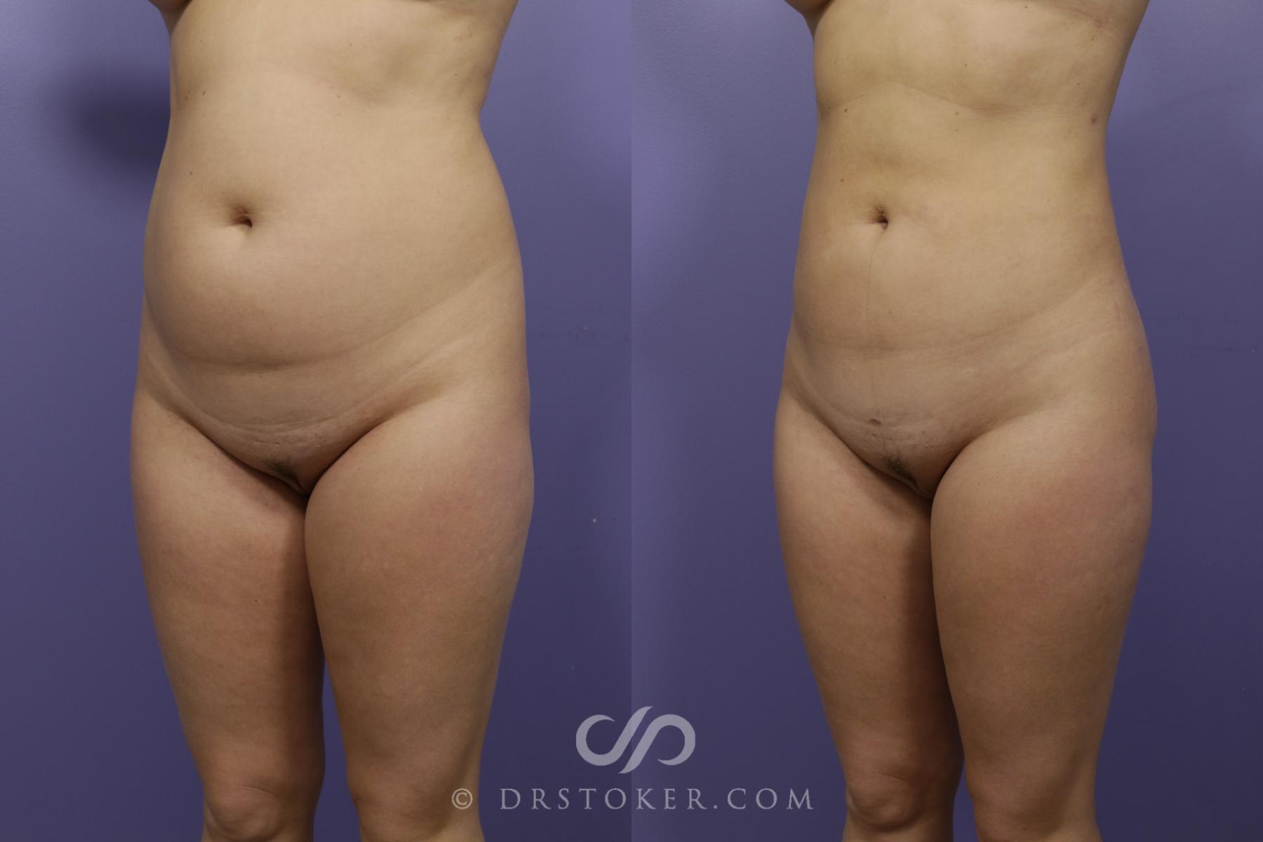Before & After Liposuction Case 1317 View #4 View in Los Angeles, CA