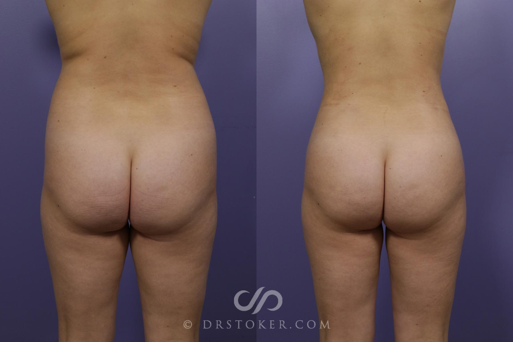 Before & After Liposuction Case 1318 View #1 View in Los Angeles, CA