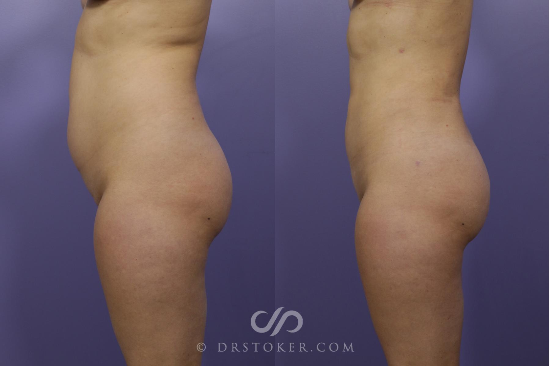 Before & After Liposuction Case 1318 View #4 View in Los Angeles, CA