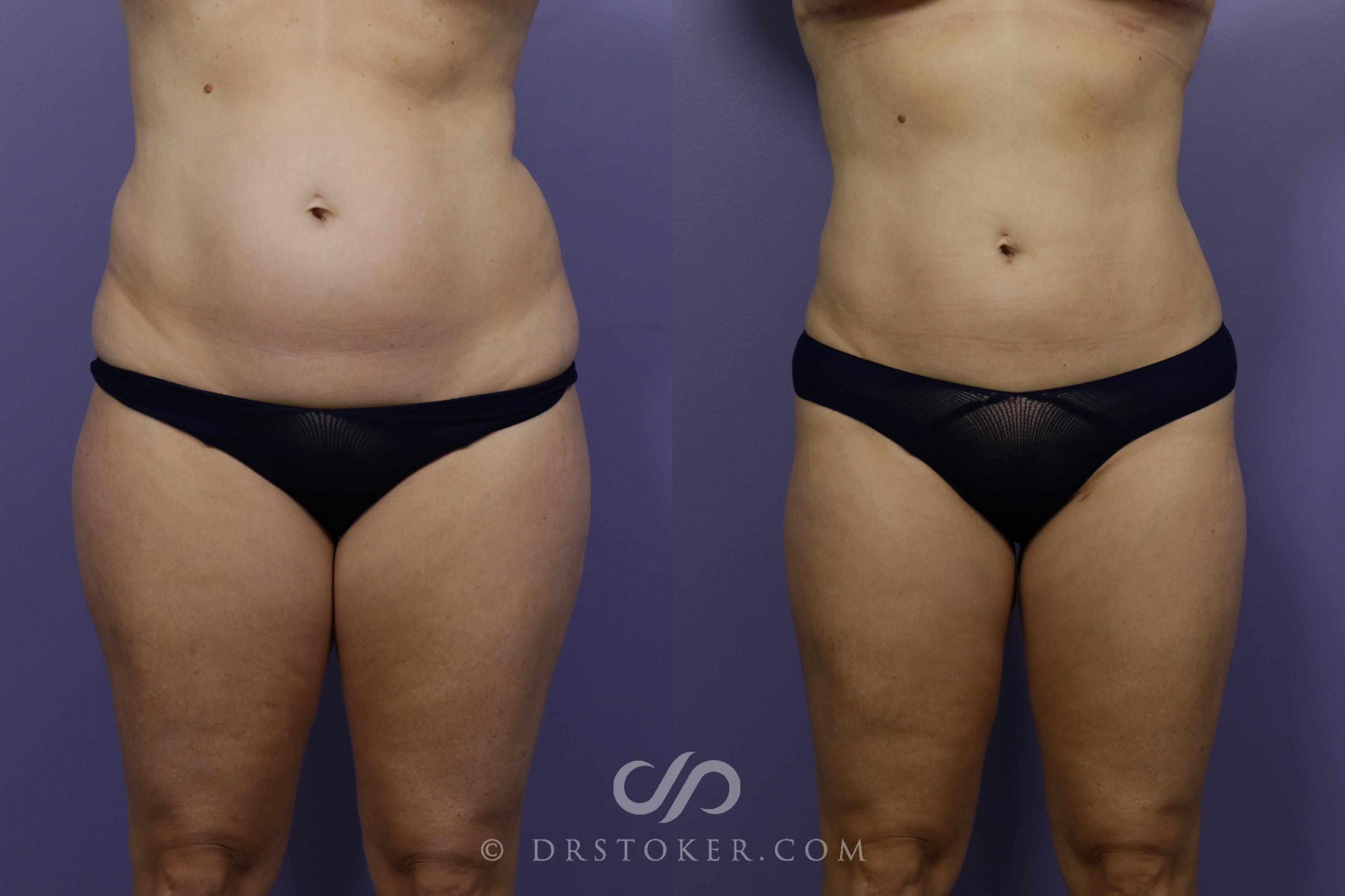 Before & After Liposuction Case 1319 View #1 View in Los Angeles, CA