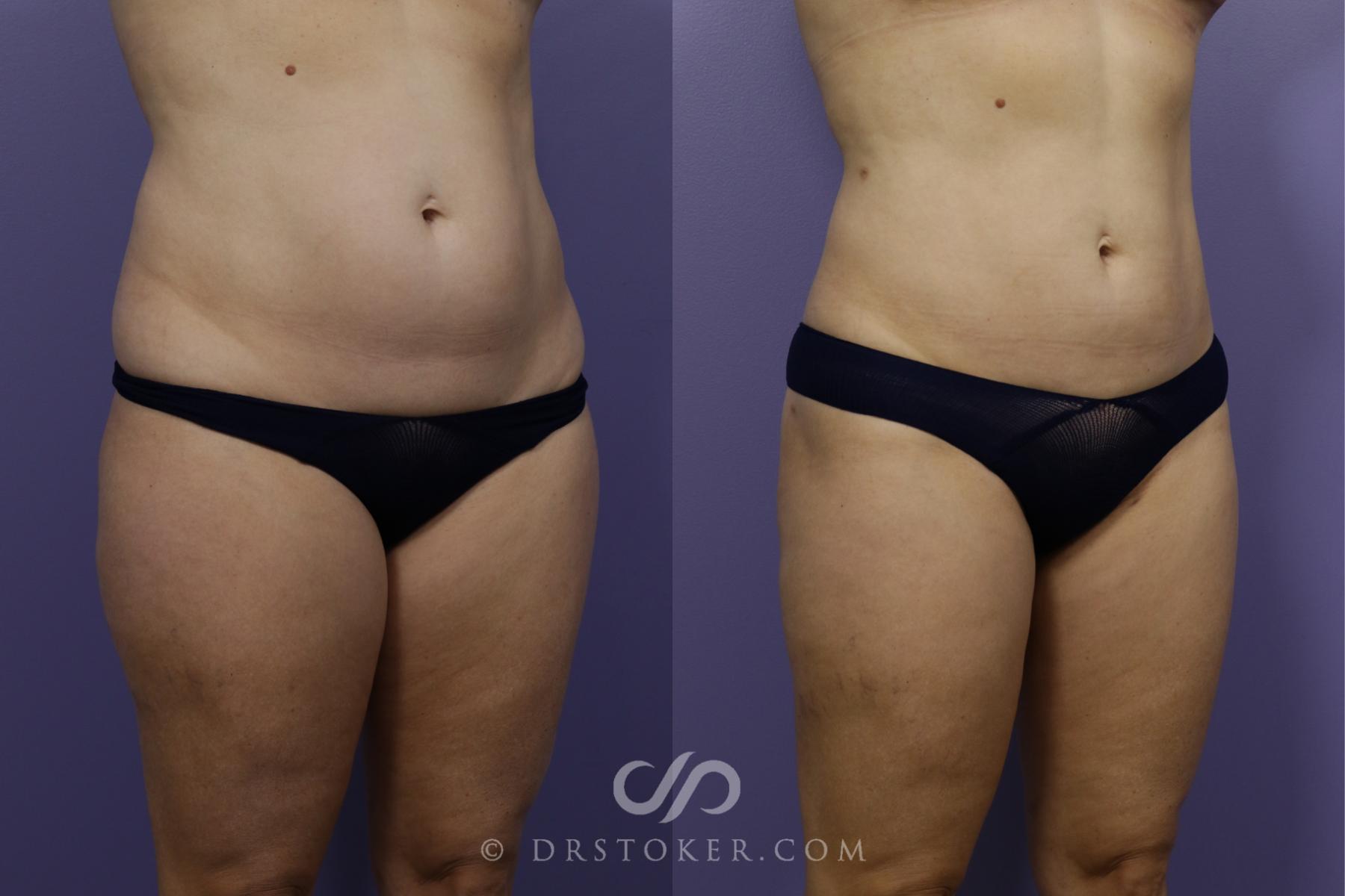 Before & After Liposuction Case 1319 View #2 View in Los Angeles, CA