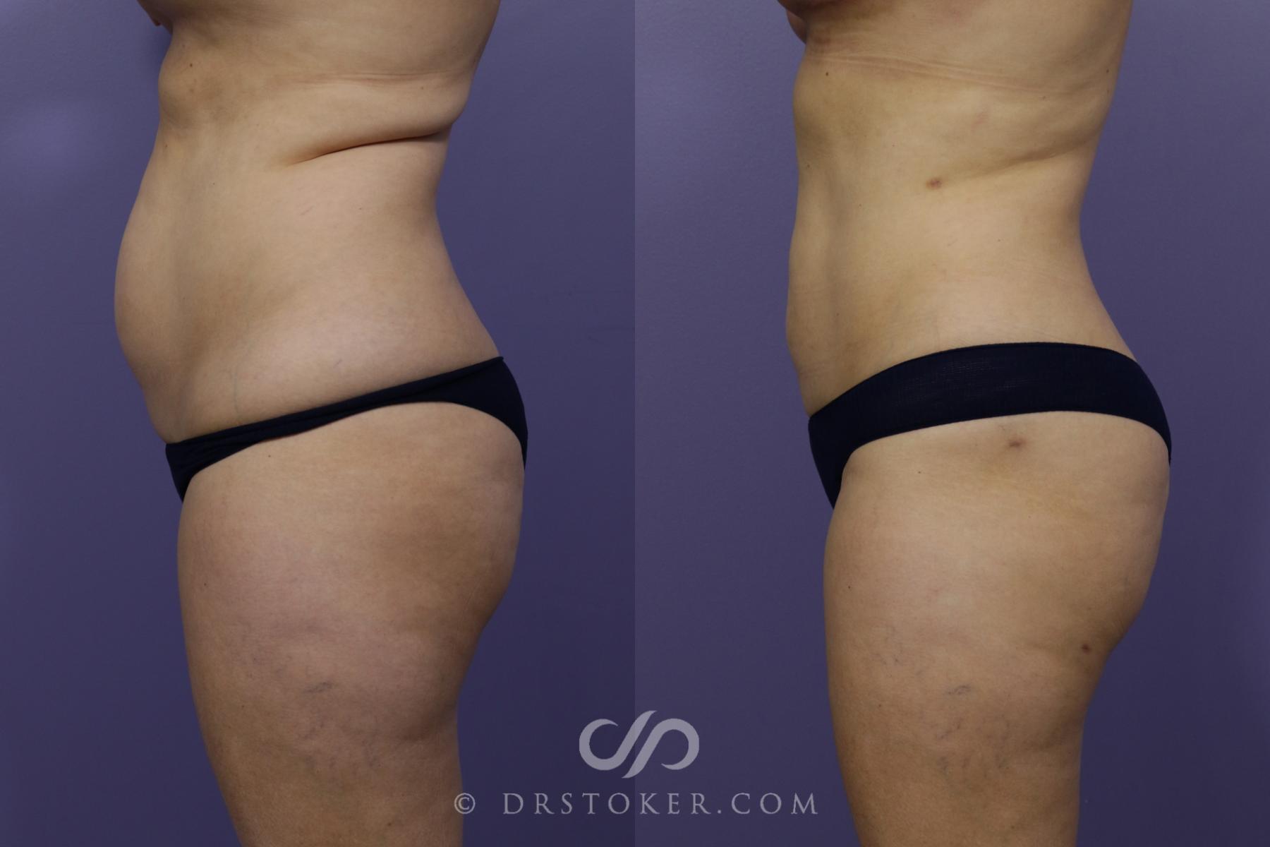 Before & After Liposuction Case 1319 View #3 View in Los Angeles, CA