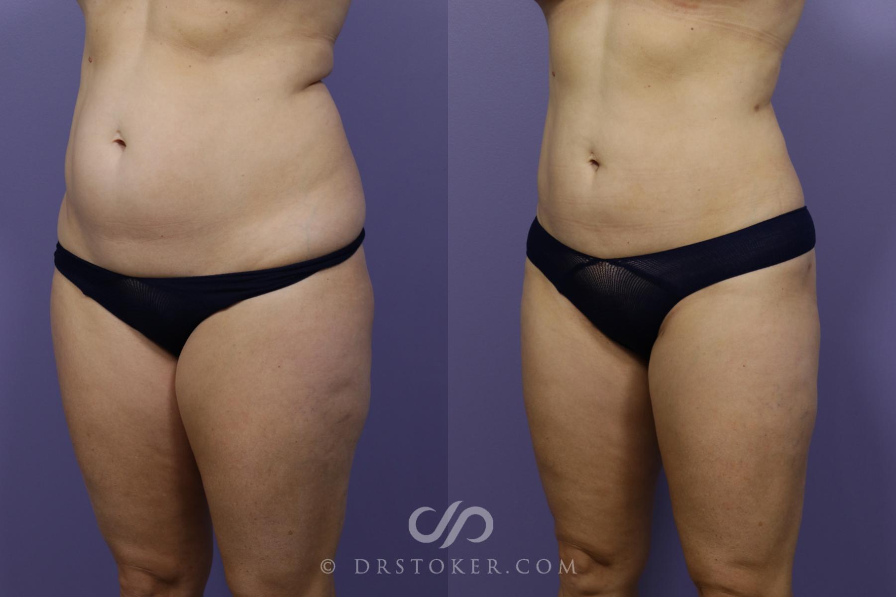 Before & After Liposuction Case 1319 View #4 View in Los Angeles, CA