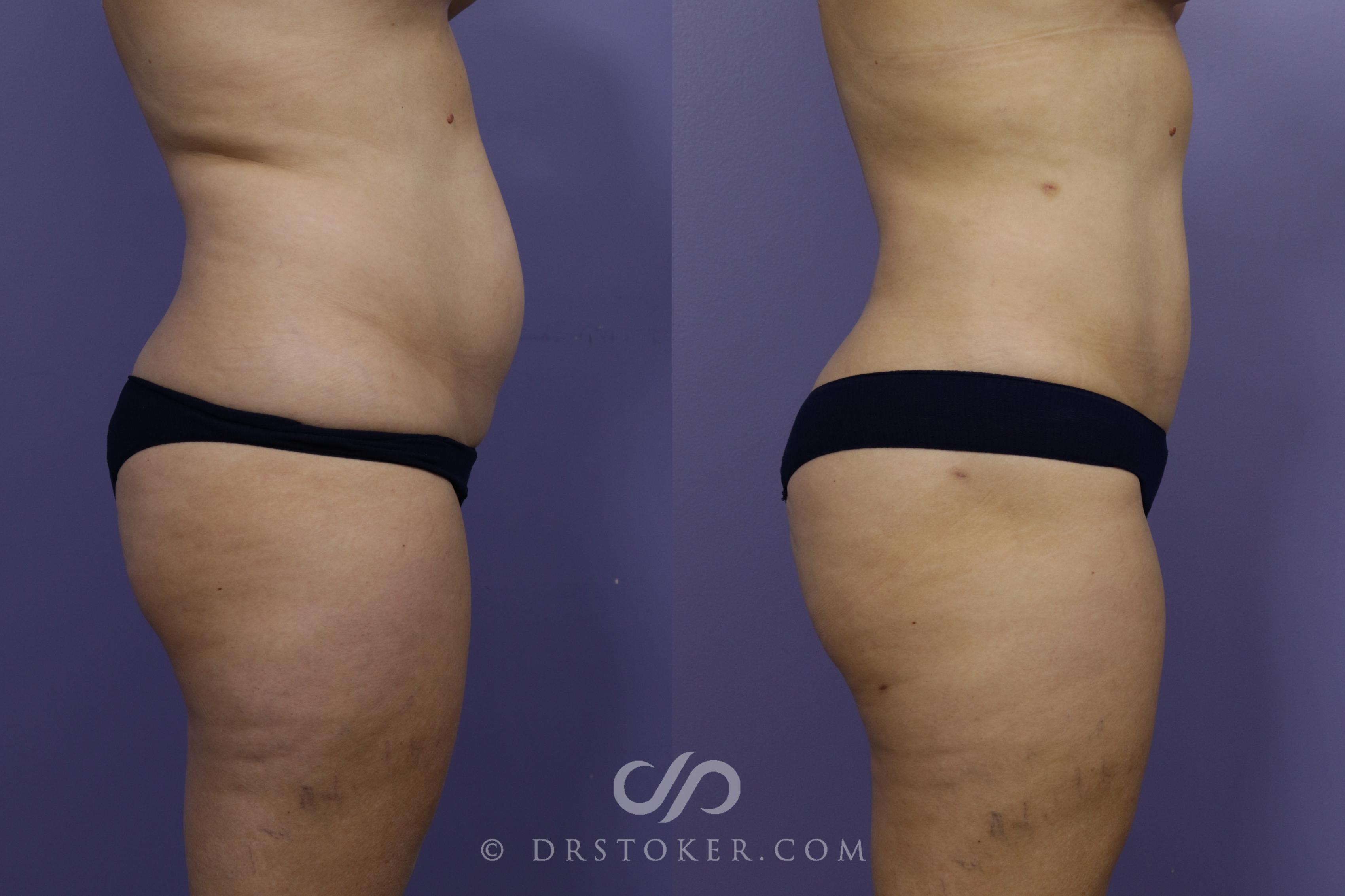 Before & After Liposuction Case 1320 View #1 View in Los Angeles, CA